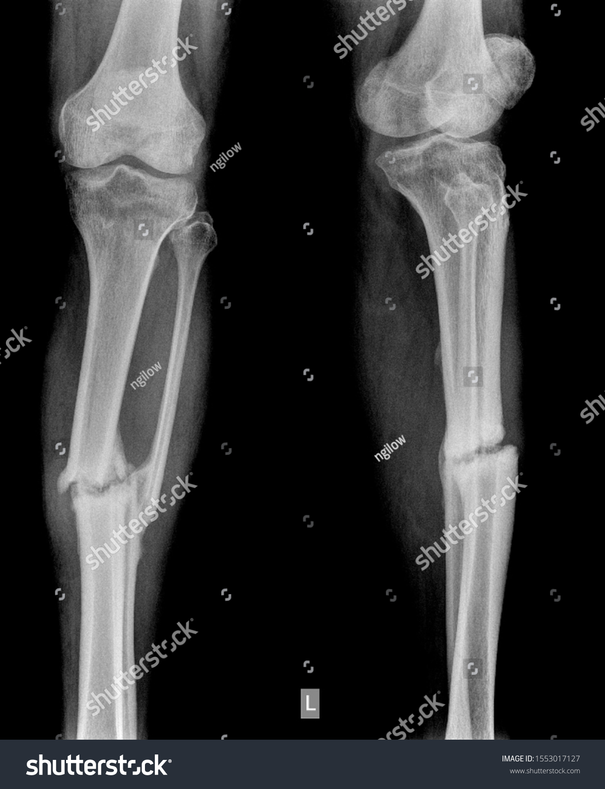 X Ray Knee Picture Radiograph Black Stock Photo 1553017127 | Shutterstock