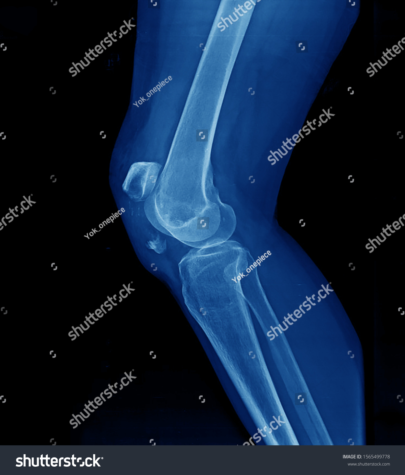 Xray Knee Showing Closed Fracture DisplacementẢnh Có Sẵn1565499778 Shutterstock