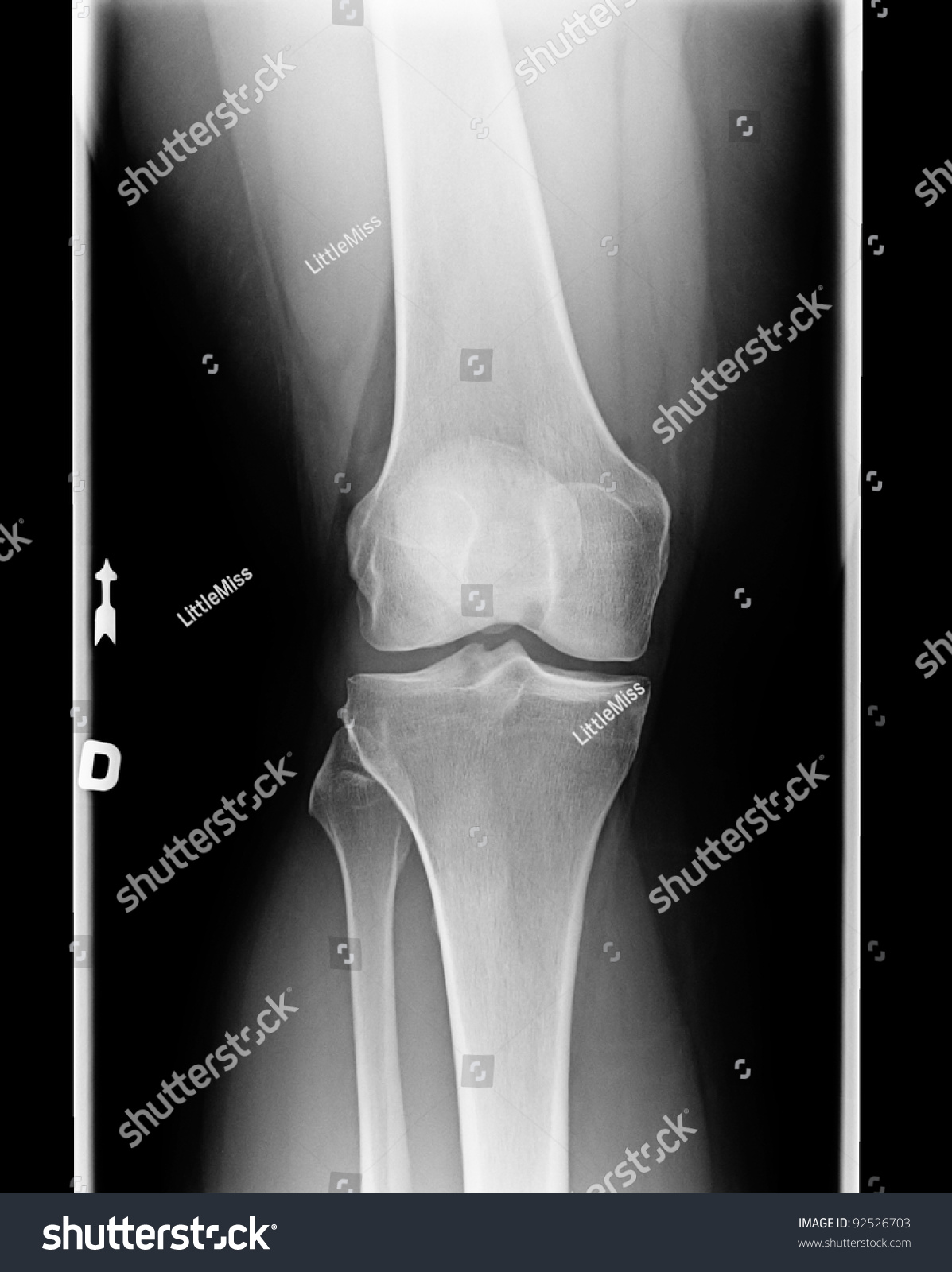 Xray Knee Chondromalacia Condition Level 1 Stock Photo 92526703 ...