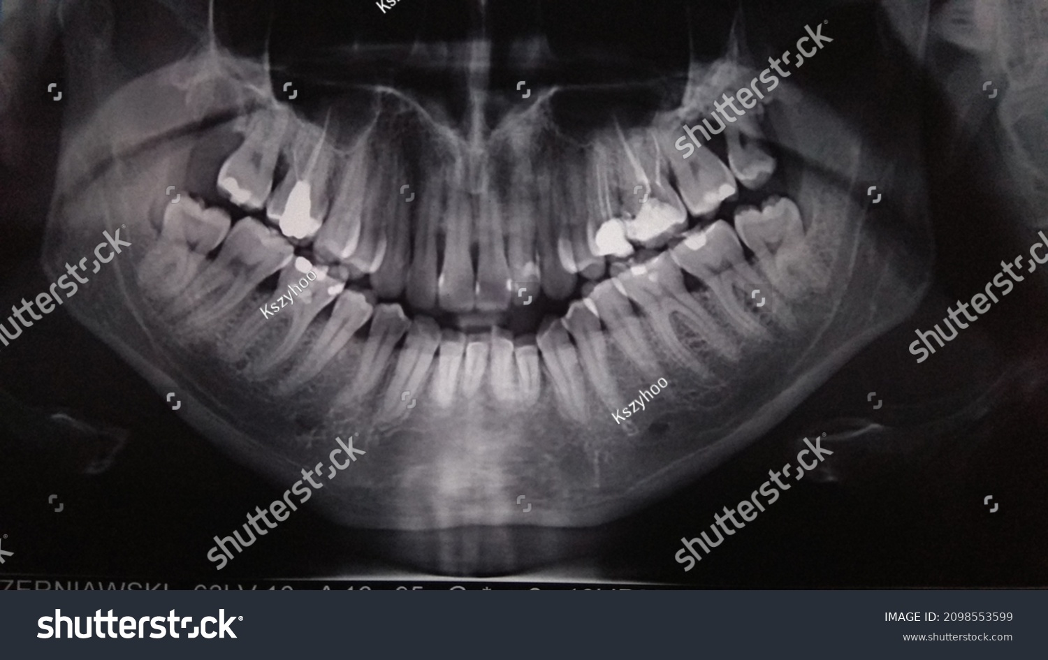 Xray Mans Jaw Black White Stock Photo 2098553599 | Shutterstock