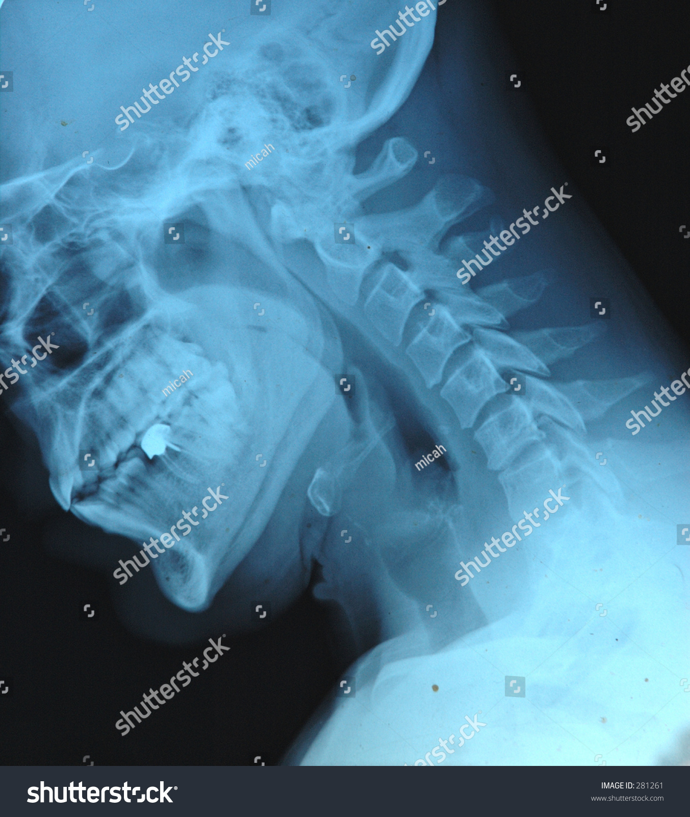 X-Ray Of Neck Stock Photo 281261 : Shutterstock