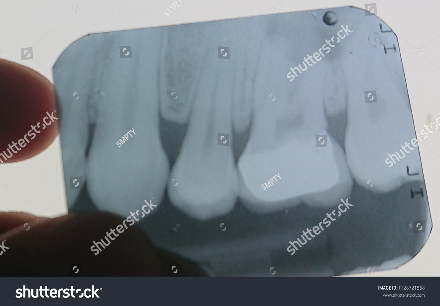 31 Abscess periapical Images, Stock Photos & Vectors | Shutterstock