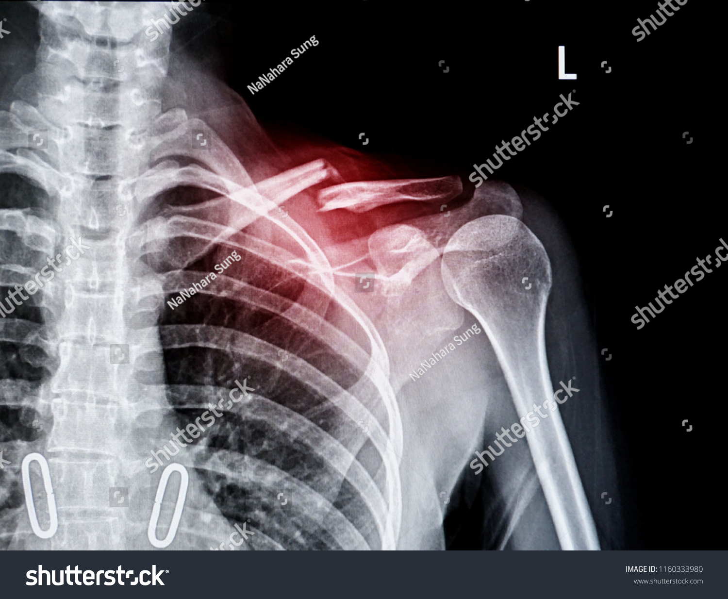 Xray Shoulder Joint Show Fracture Clavicle Foto Stock Shutterstock