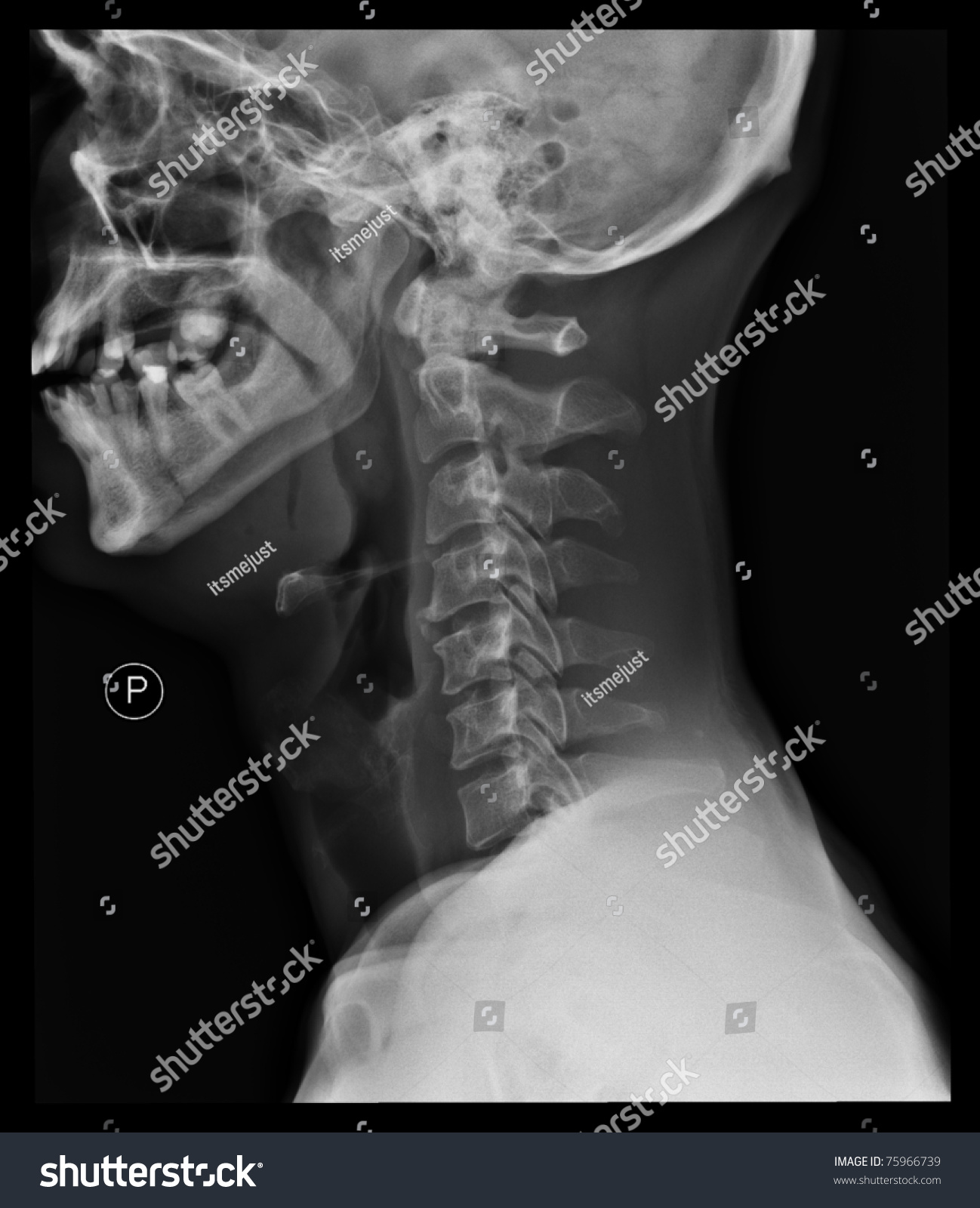 Xray Cervical Spine Many Others Xray Stock Photo 75966739 - Shutterstock