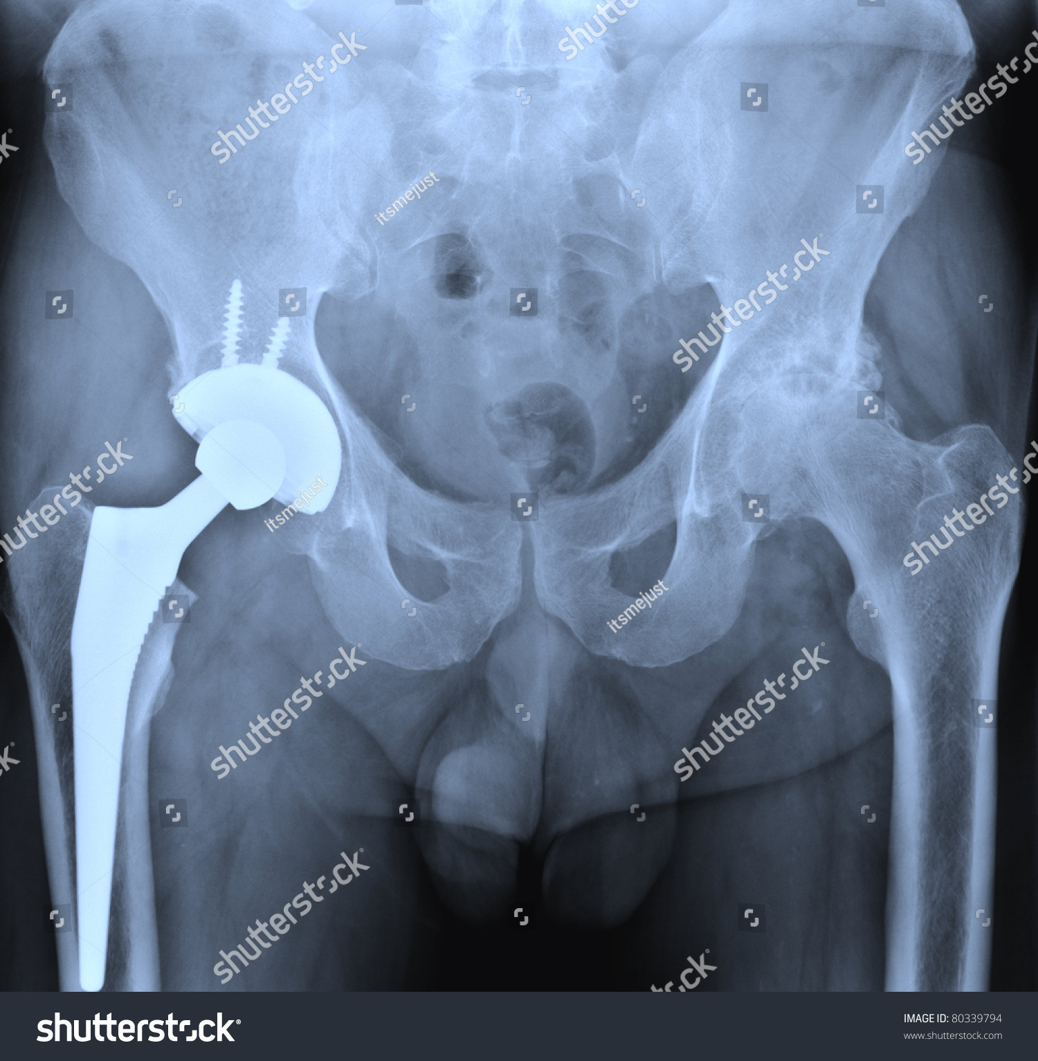 Xray Hip Prosthesis Many Others Xray Stock Photo 80339794 - Shutterstock