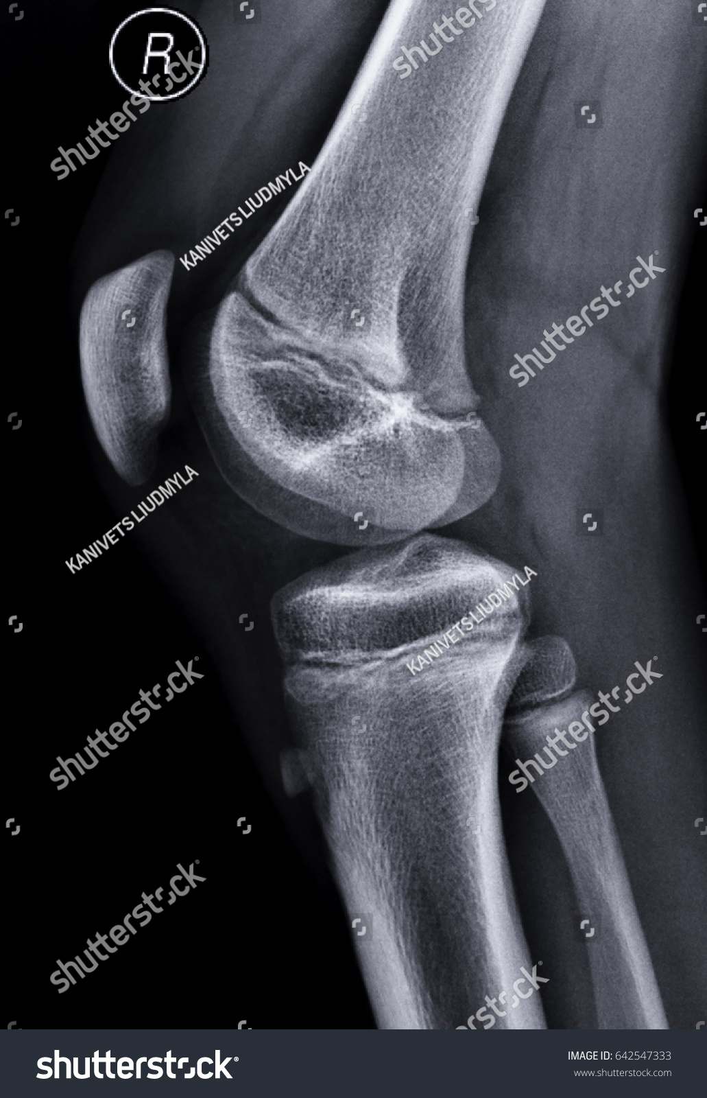 Xray Knee Stock Photo (Edit Now) 642547333