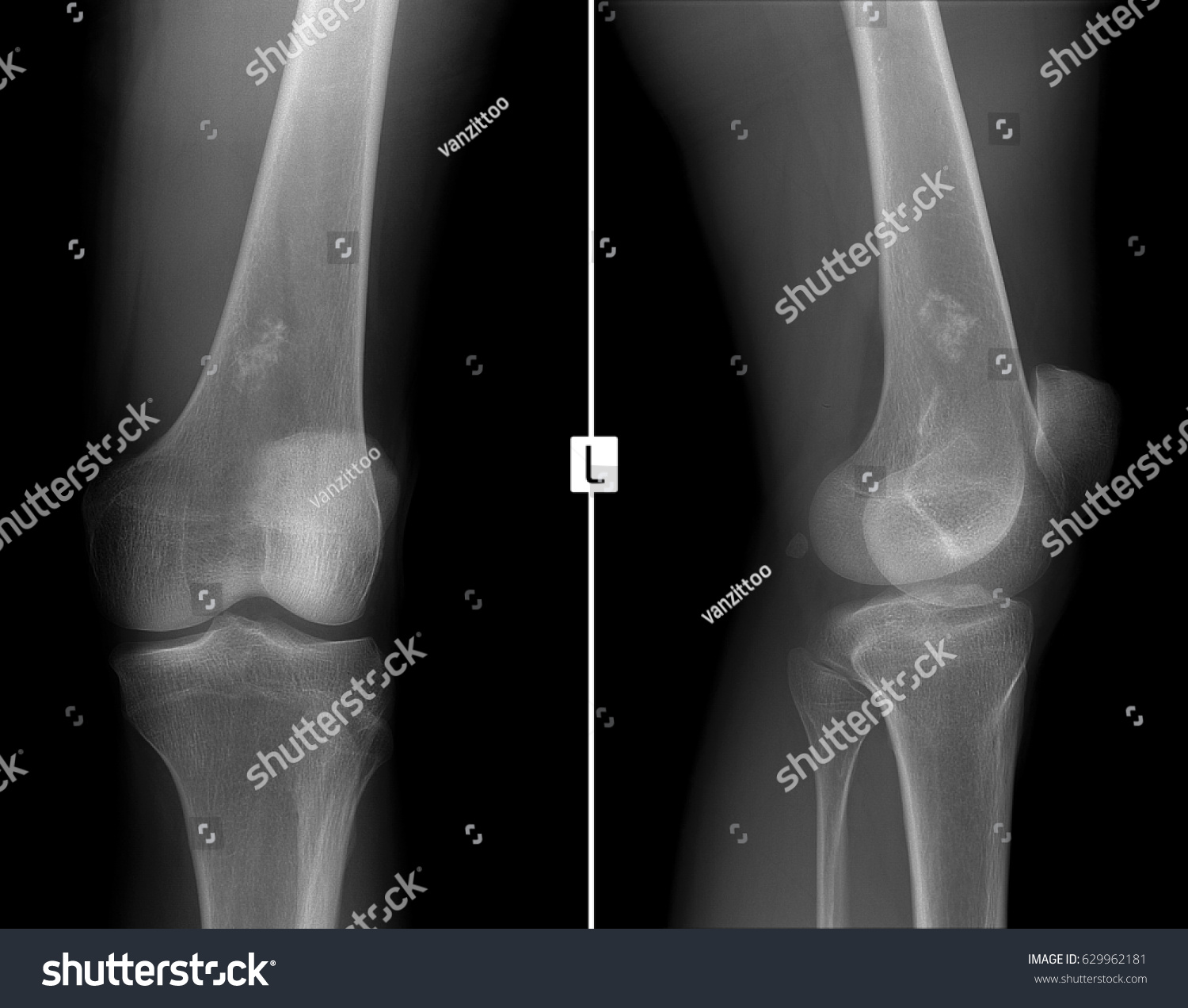 Xray Left Knee Joint Ewing Sarcoma Stock Photo (Edit Now) 629962181