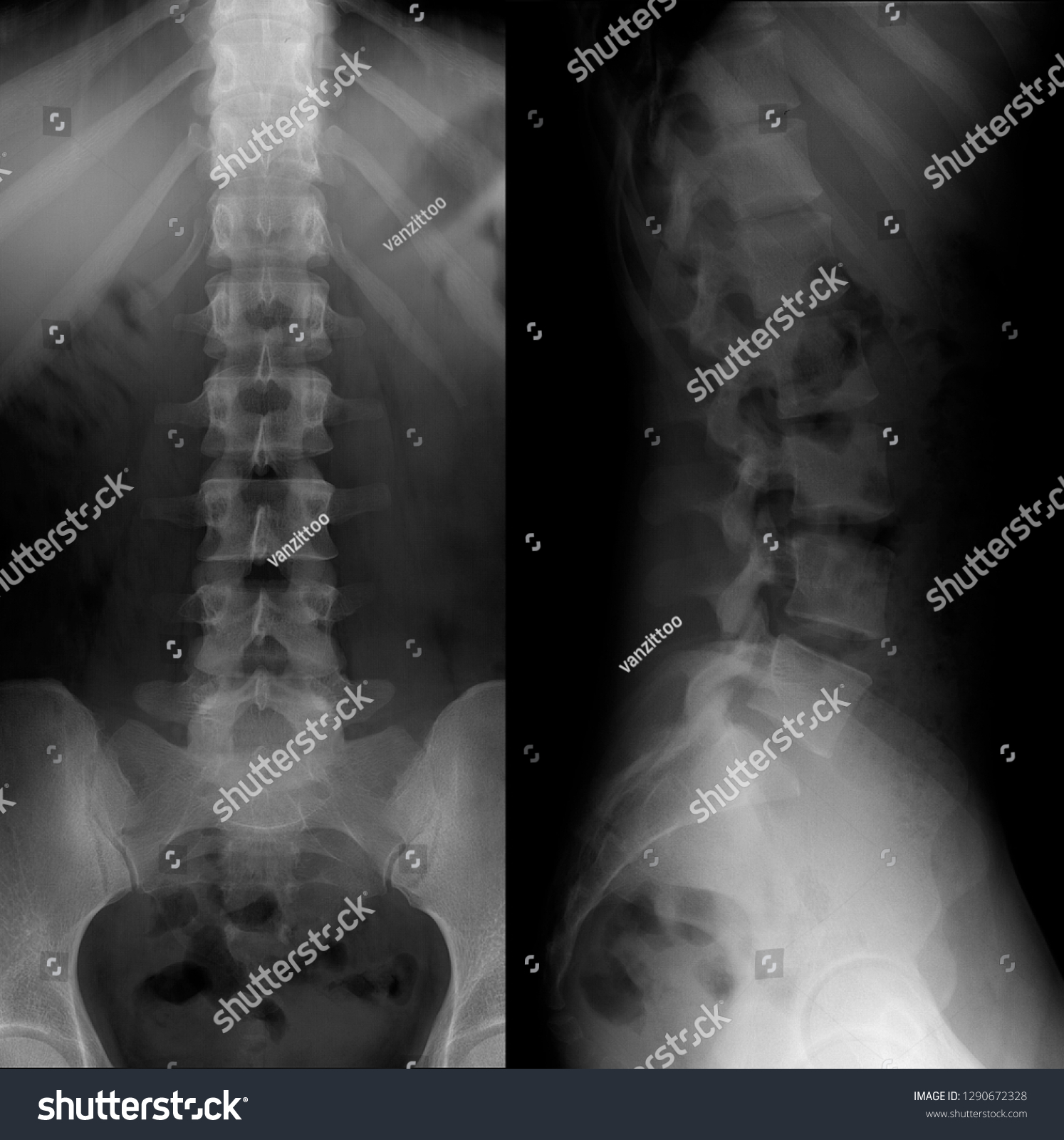 Xray Lumbosacral Spine Normal Perfect Stock Photo 1290672328 | Shutterstock