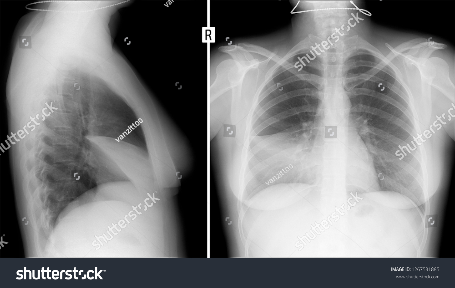 Xray Lungs Pleurisy Right Stock Photo 1267531885 