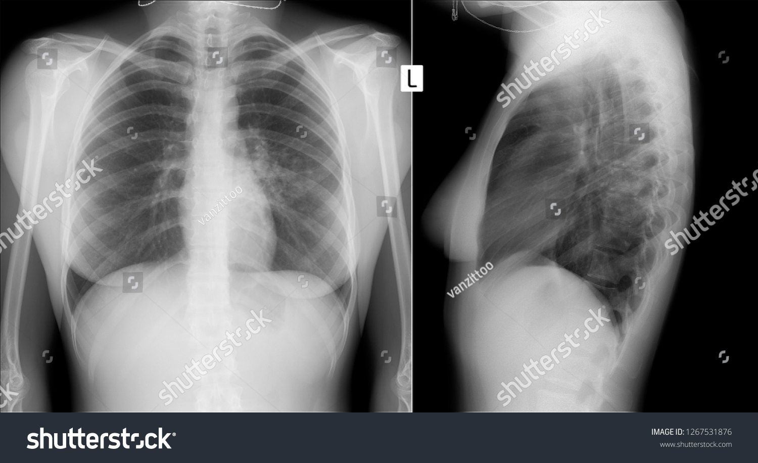 Xray Lungs Pneumonia Lung Left S6 Stock Photo (Edit Now) 1267531876