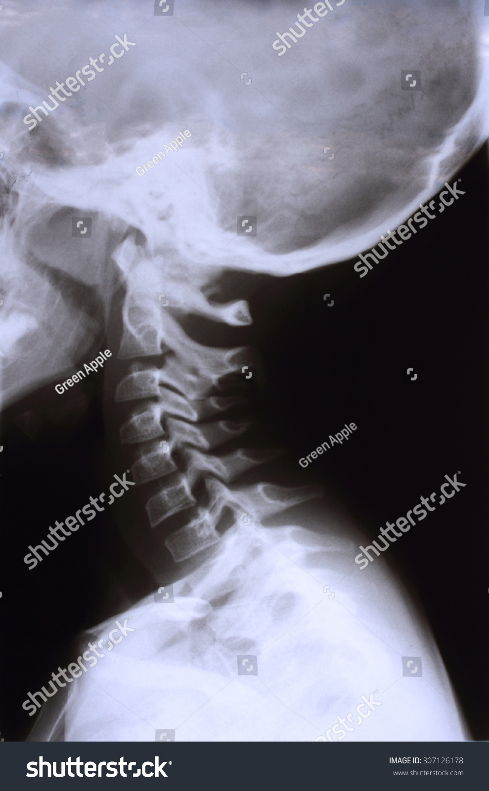 XRay Of The Neck And The Head Stock Photo 307126178 Shutterstock