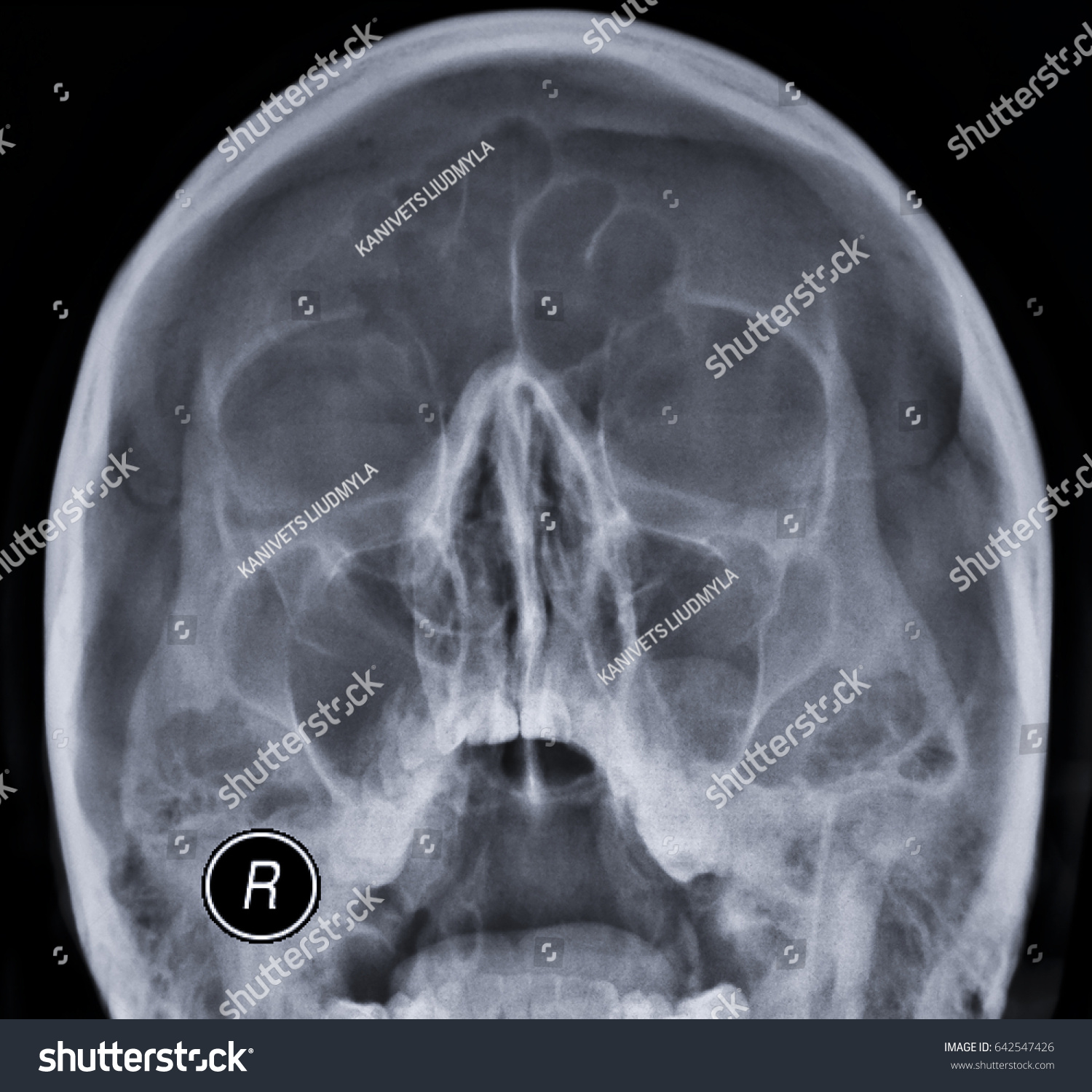 Xray Paranasal Sinuses Stock Photo Edit Now 642547426