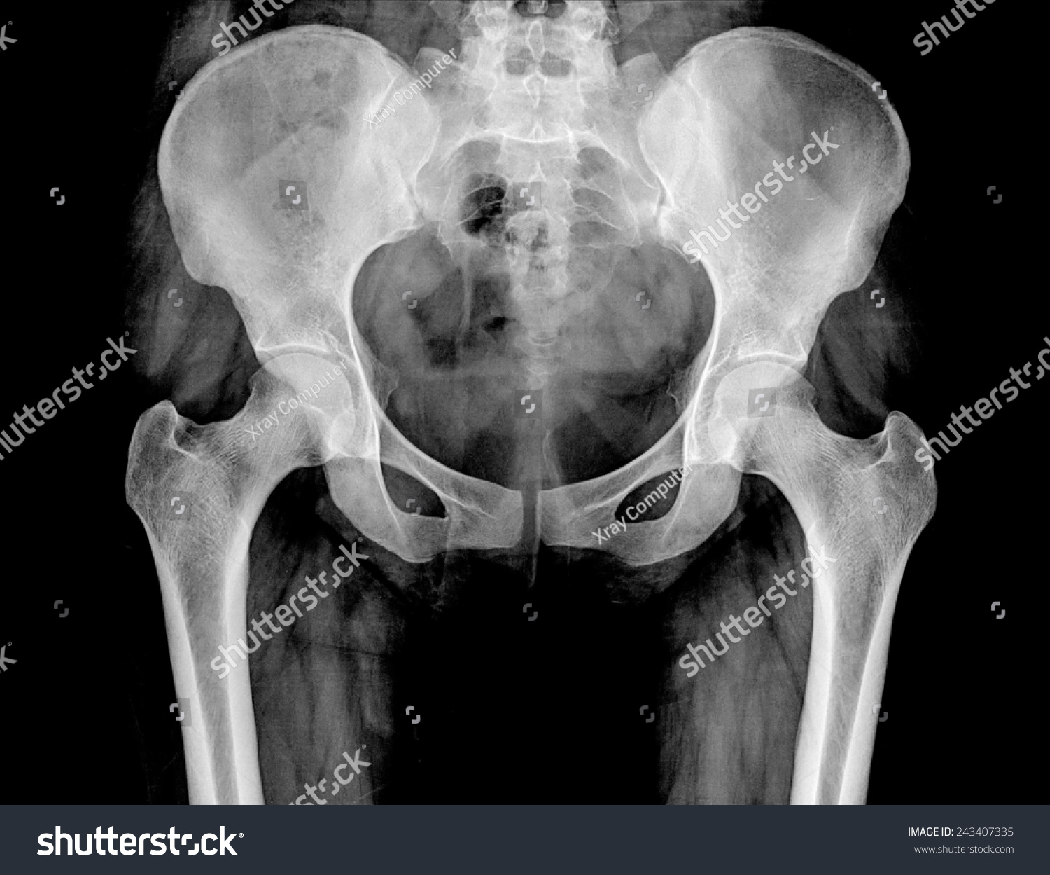 Normal Female Spine X Ray