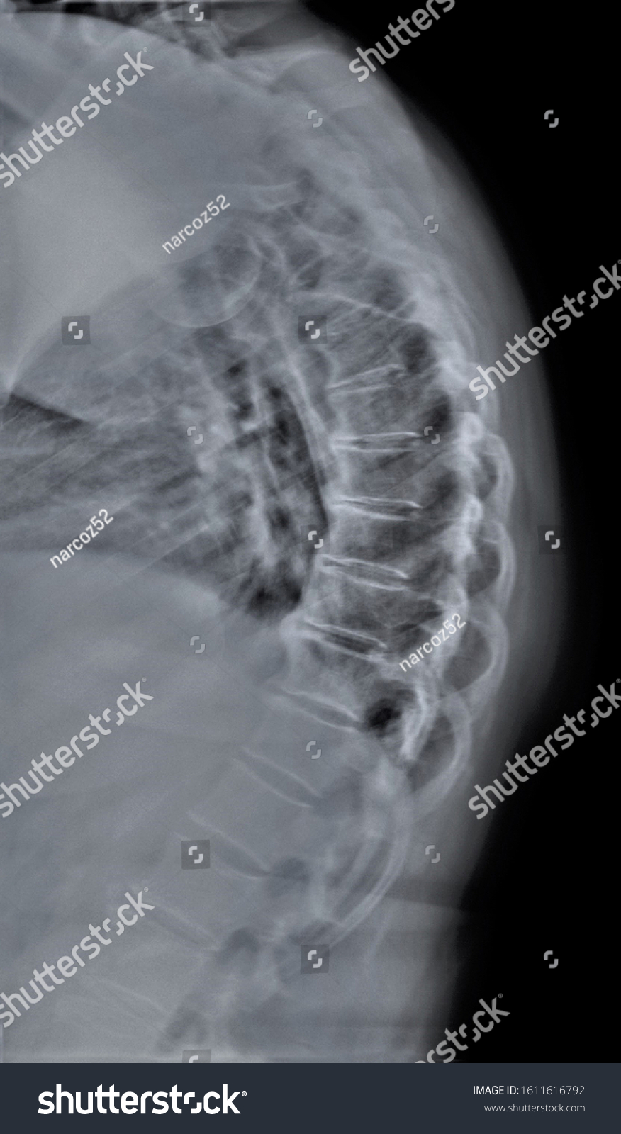 Xray Thoracic Spine Lateral Projection Stock Photo Edit Now