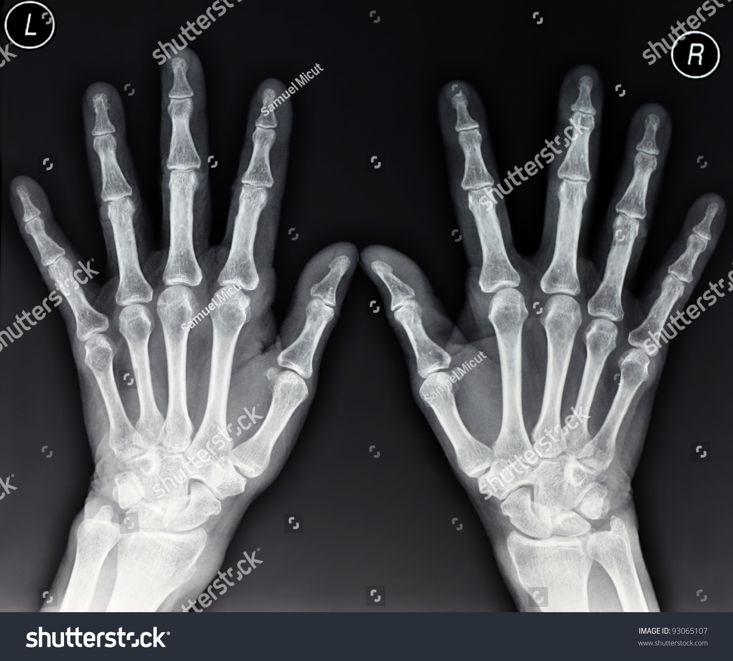 Xray Two Hands Extended Frontal View Stock Photo 93065107 - Shutterstock