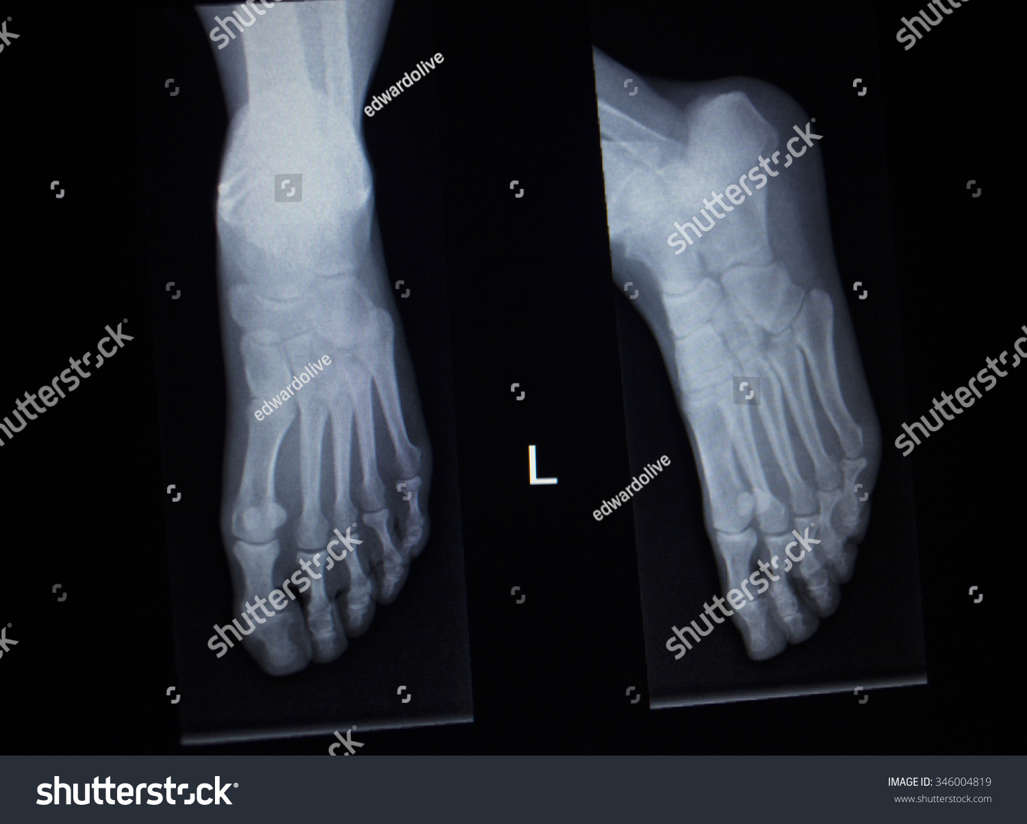 Xray Orthopedic Medical Anterior Posterior Ap Stock Photo (Edit Now ...