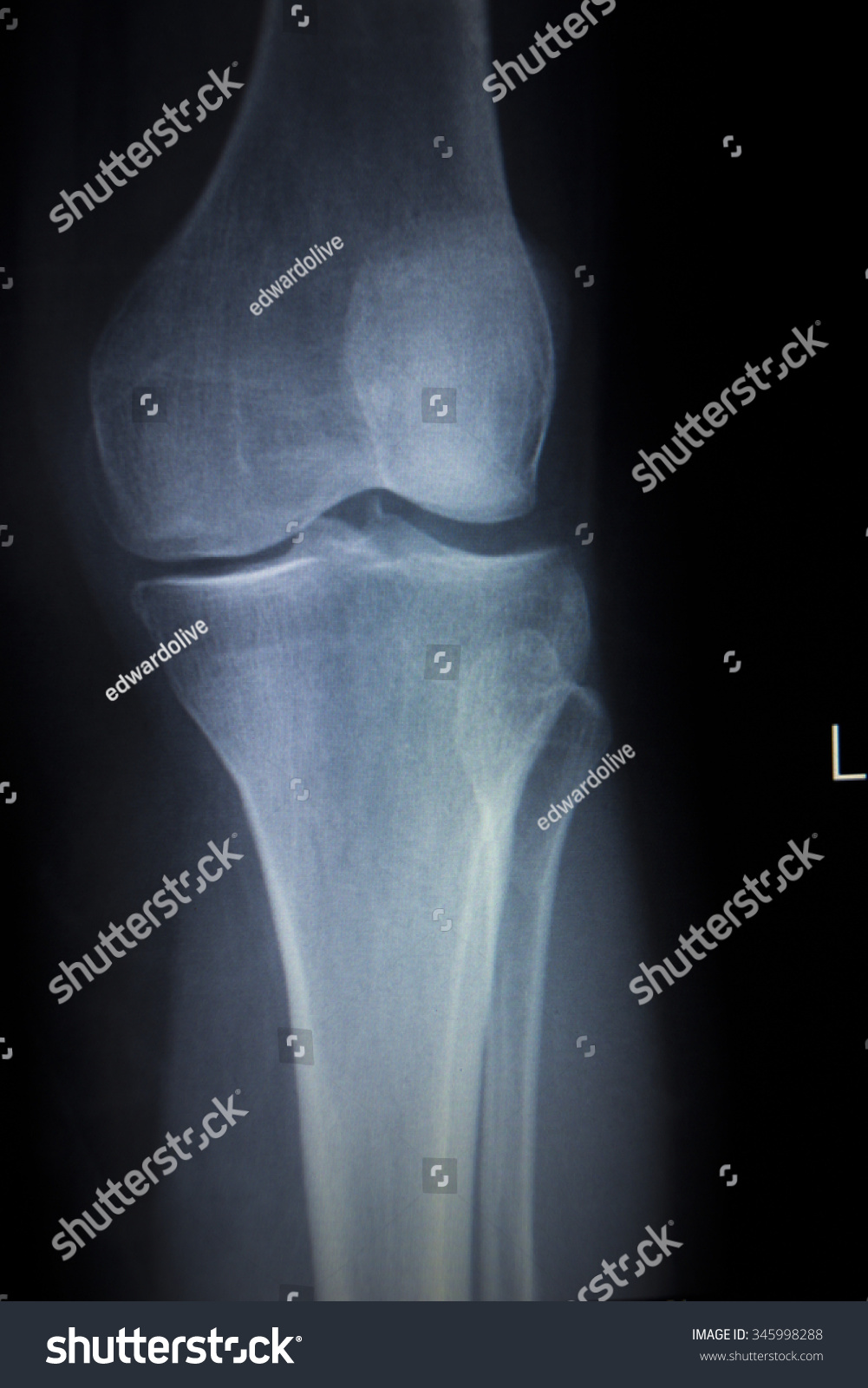 Xray Orthopedic Medical Cat Scan Painful Stock Photo 345998288 ...