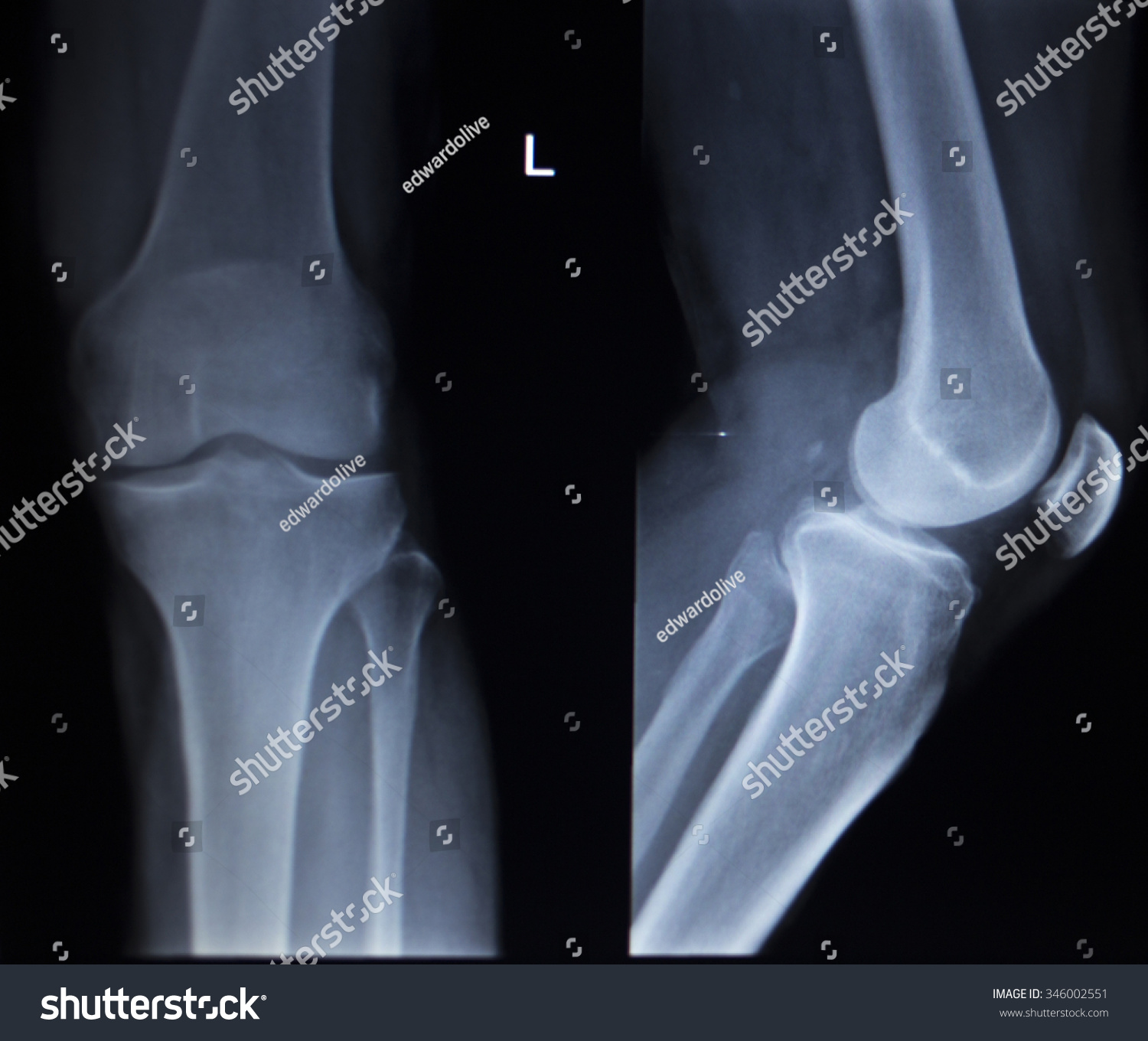 Xray Orthopedic Medical Cat Scan Painful Stock Photo (Edit Now) 346002551