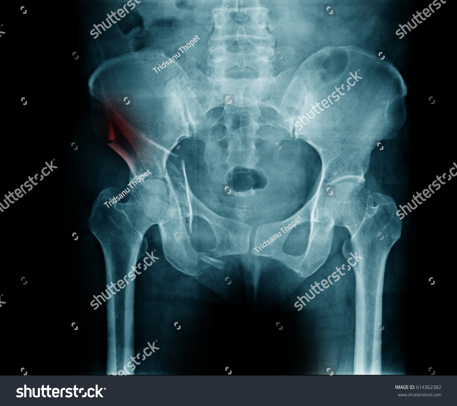 Xray Pelvis Show Fracture Pelvic Bone Stockfoto Jetzt Bearbeiten 614362382