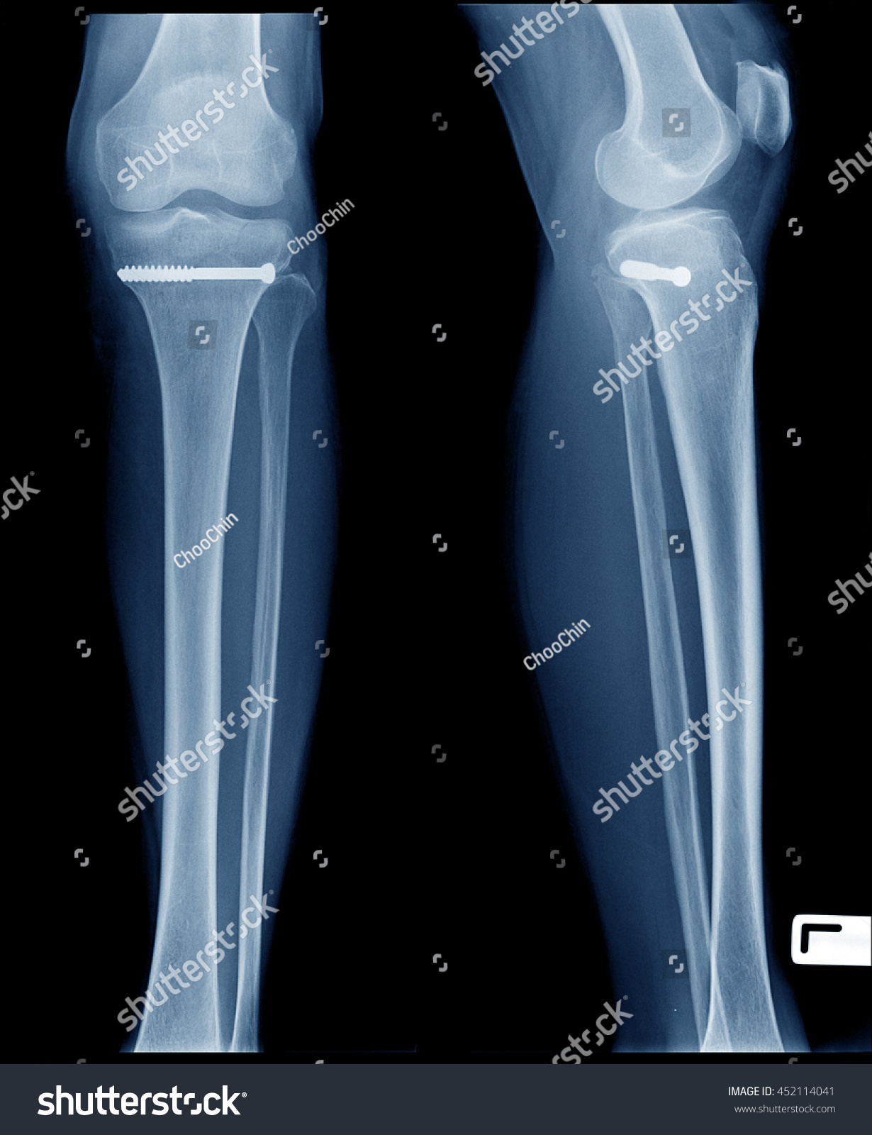 knee fracture surgery