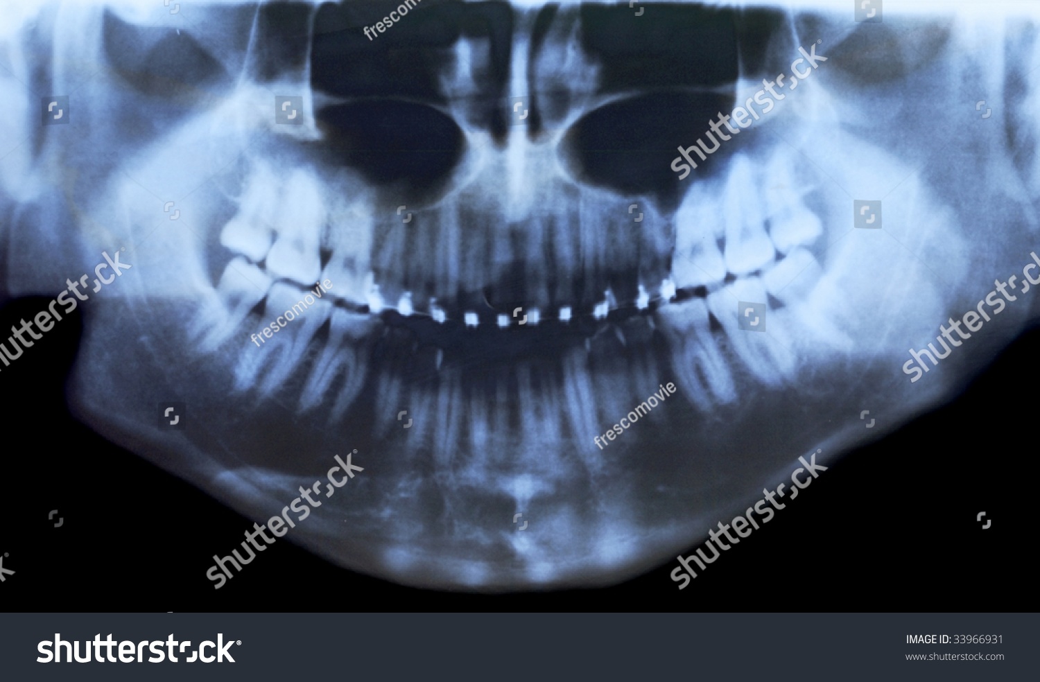 X-Ray Photo Of Teeth With Braces - 33966931 : Shutterstock