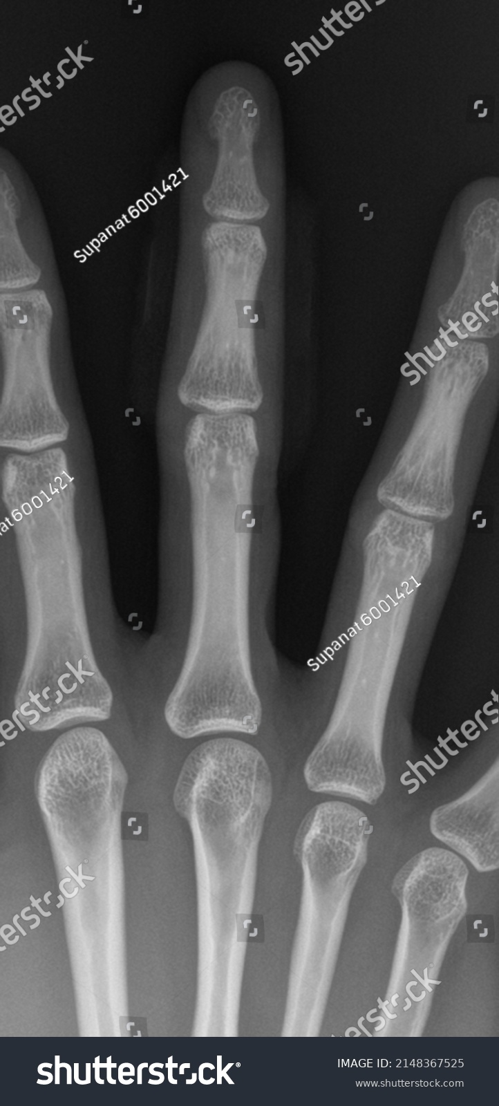Xray Photograph Middle Finger Lateral Ap Stock Photo Shutterstock