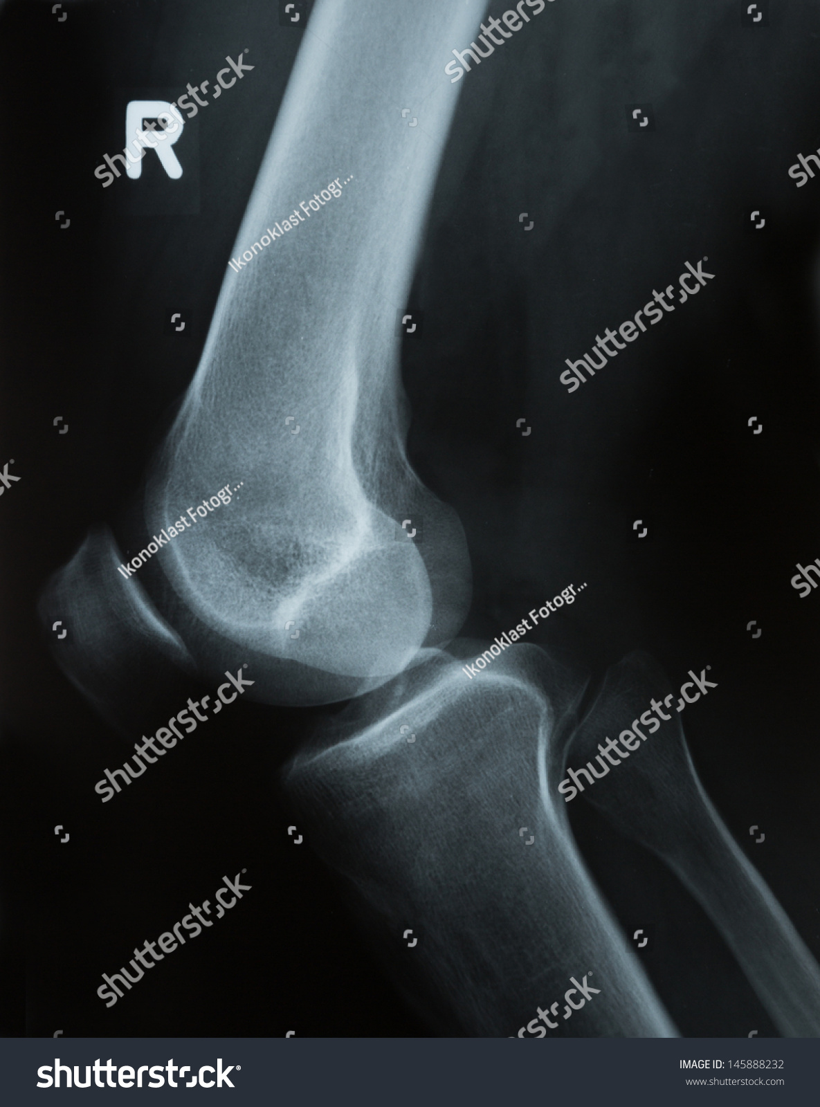 X-Ray Photograph Or Roentgen Image Of A Human Knee With Tibia, Femur ...