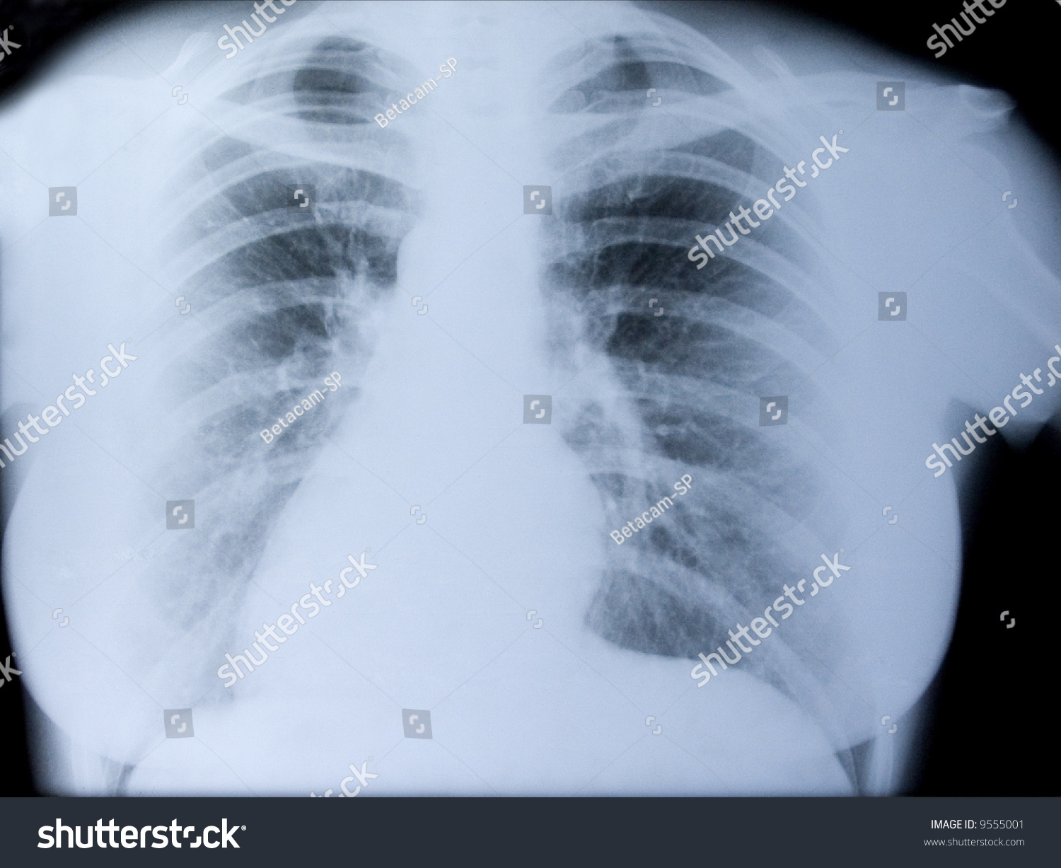 Xray Picture Thorax Woman Stock Photo (Edit Now) 9555001