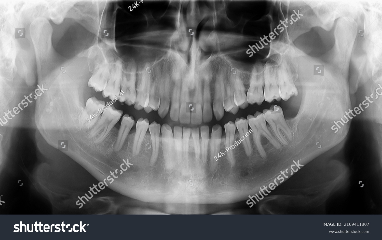 Xray Radiograph Picture Showing Human Jaw Stock Photo 2169411807 ...