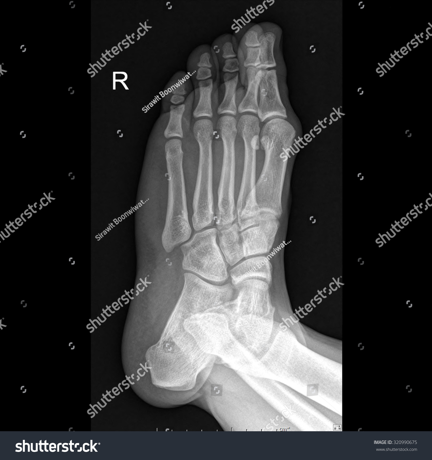 X-Ray Right Foot Human Oblique View Stock Photo 320990675 : Shutterstock