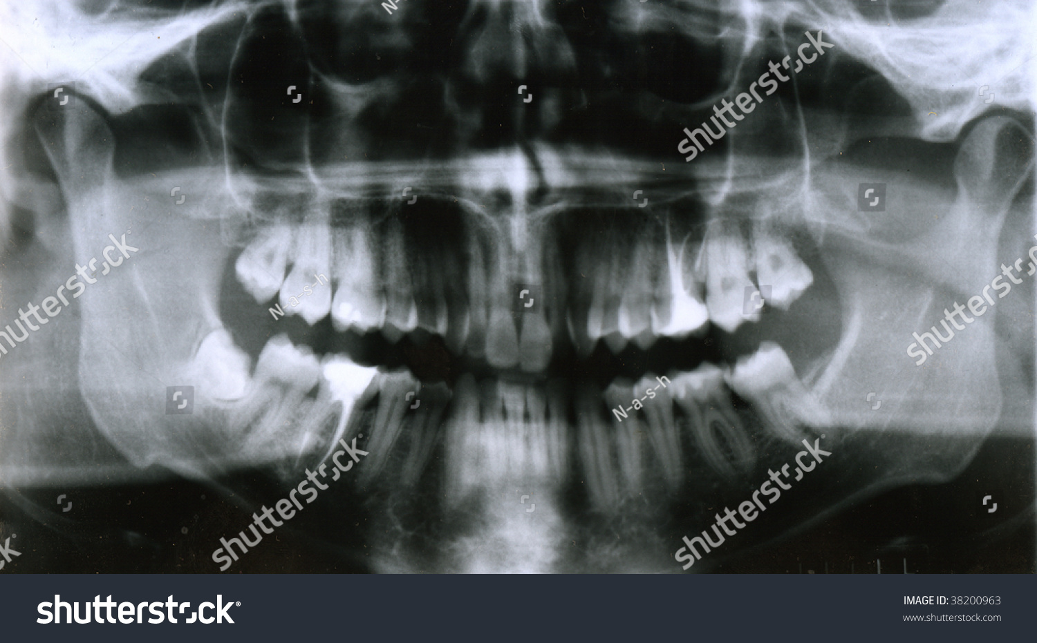 Xray Shoot Human Mouth Teeth Stock Photo (Edit Now) 38200963