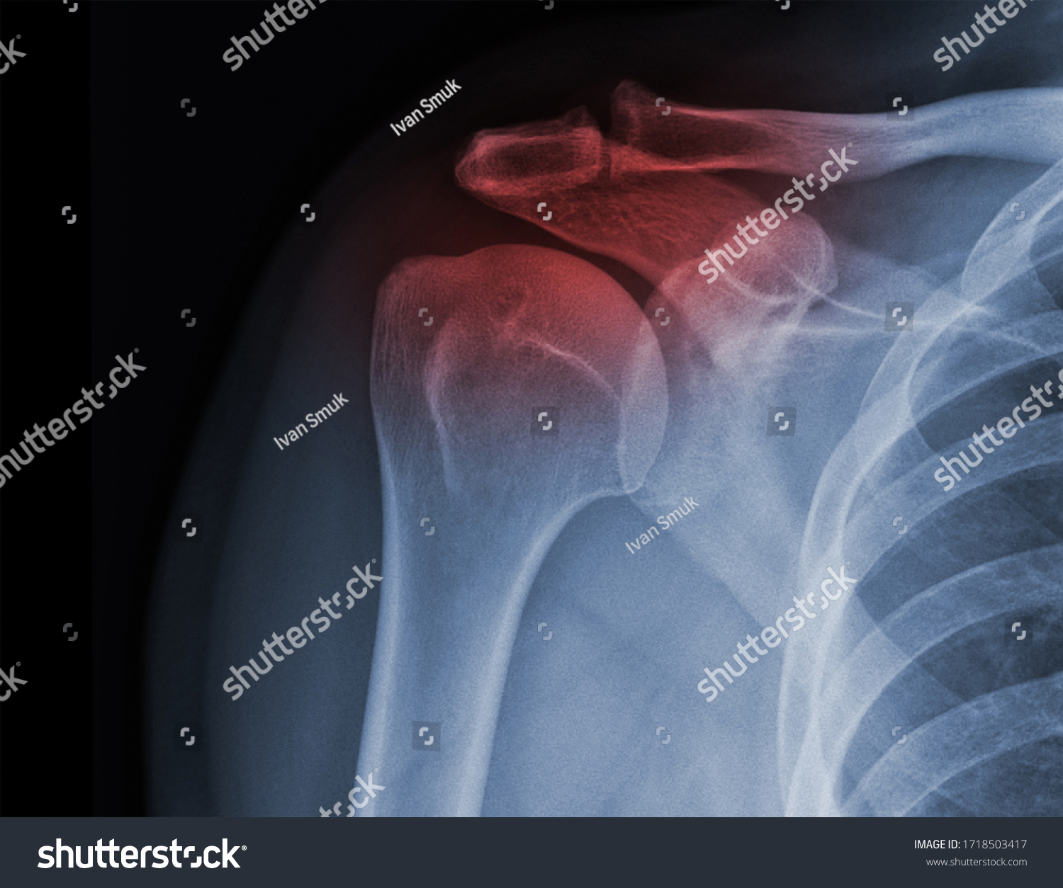 Xray Shoulder Radiograph Show State Injury Stock Photo 1718503417 ...