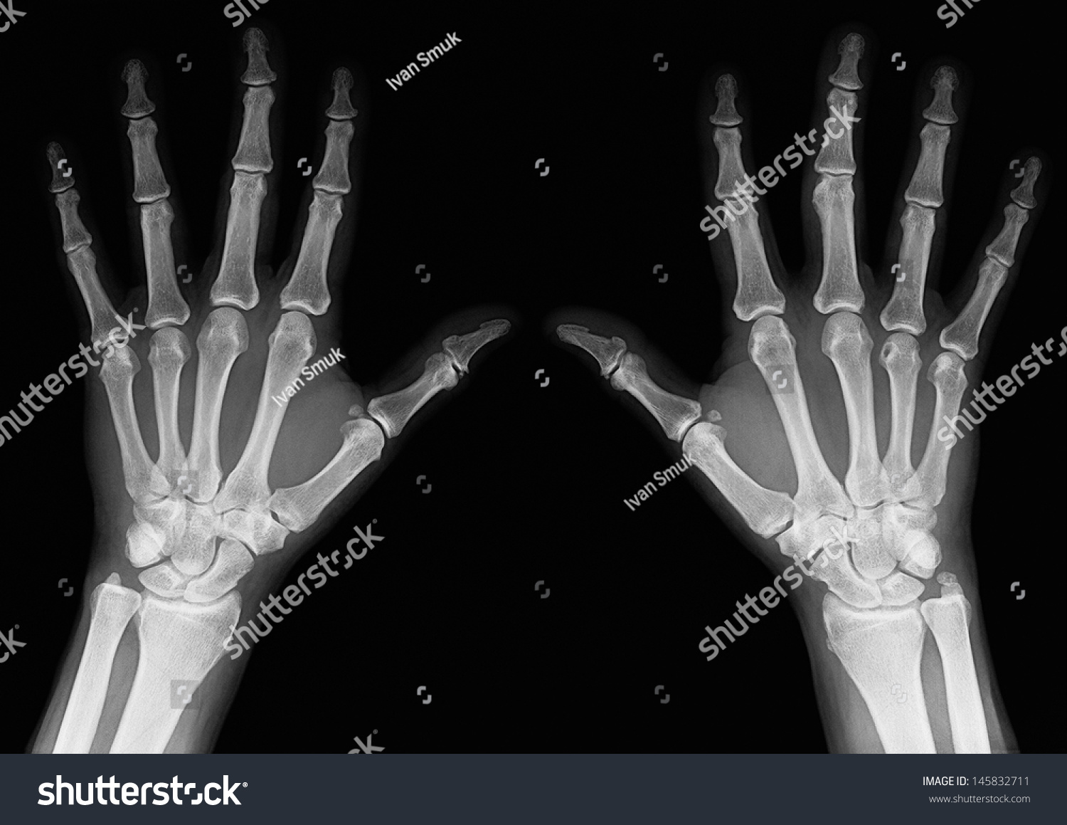 Xrays Hands Adult Man Visible Damage Stock Photo 145832711 - Shutterstock