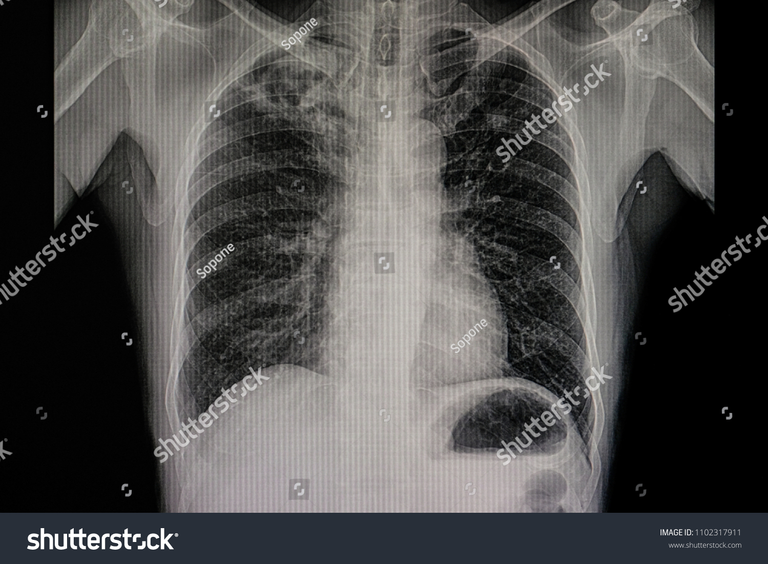 Xray Film Patient Active Pulmonary Tuberculosis Stock Photo Shutterstock