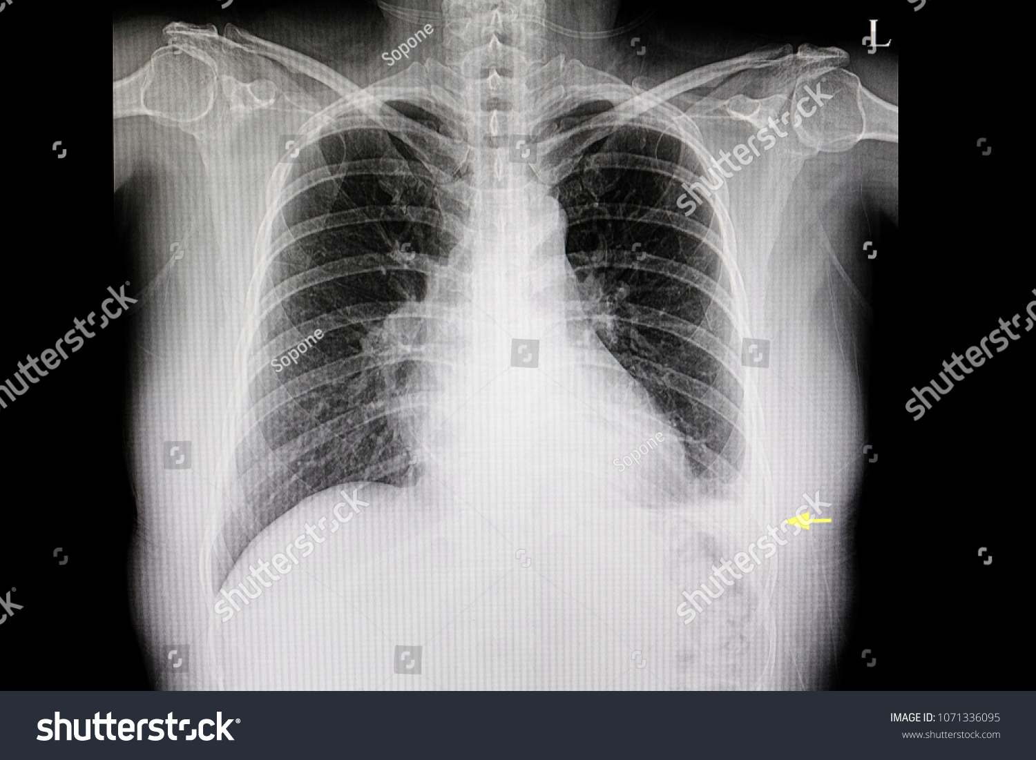 Xray Film Patient Minimal Left Pleural Stock Photo 1071336095 ...