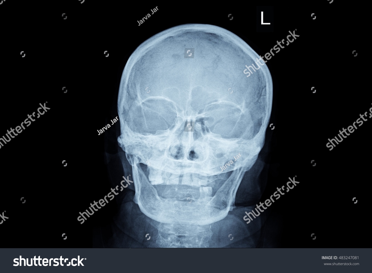 Xray Human Skull Stock Photo 483247081 | Shutterstock