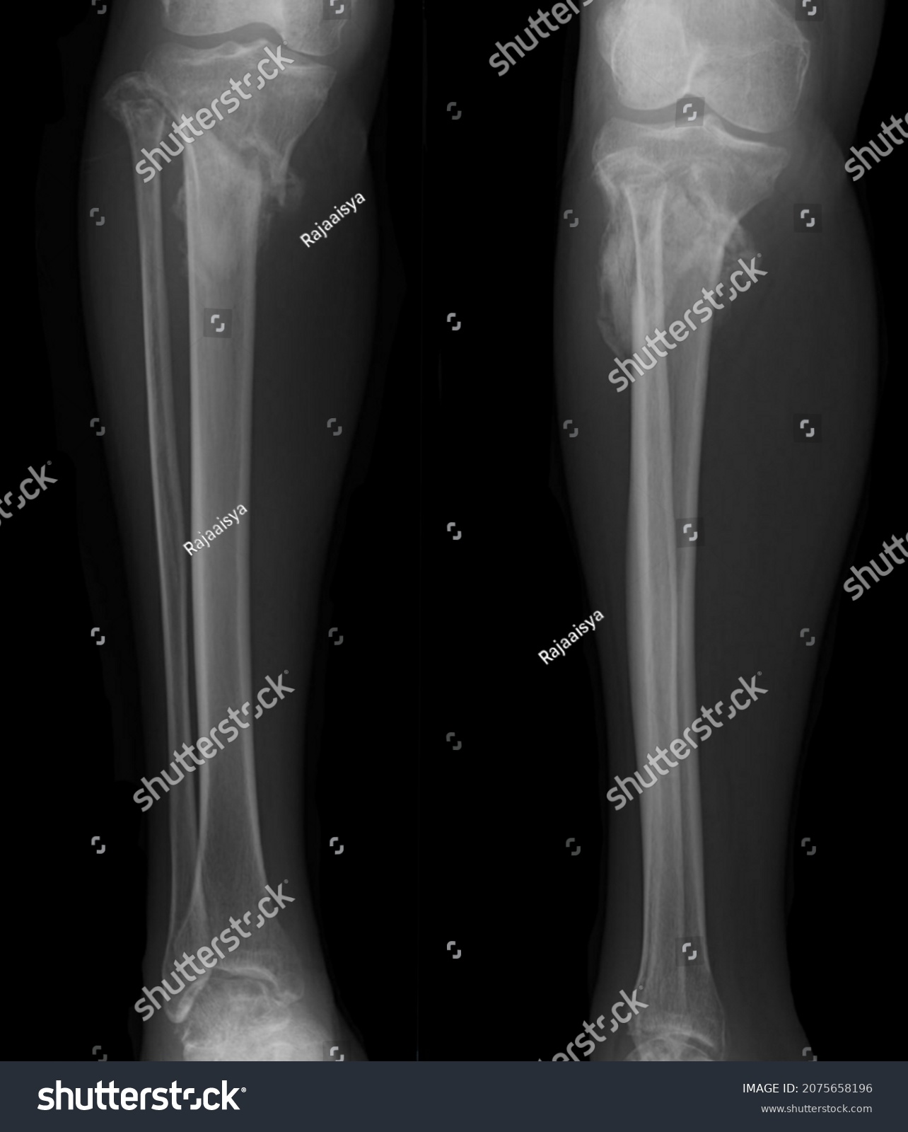 Xray Image Old Fraktur Tibia Fibula Stock Photo (Edit Now) 2075658196