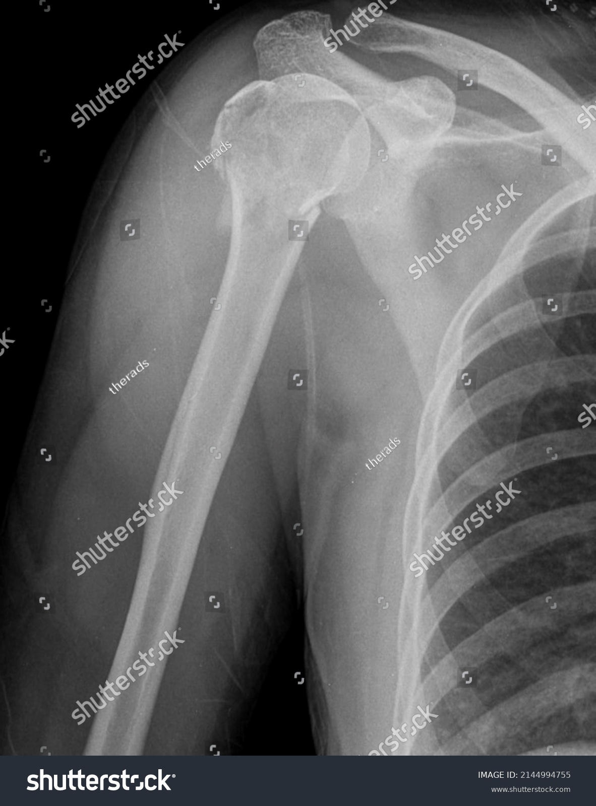 Xray Image Proximal Humerus Fracture Stock Photo 2144994755 | Shutterstock