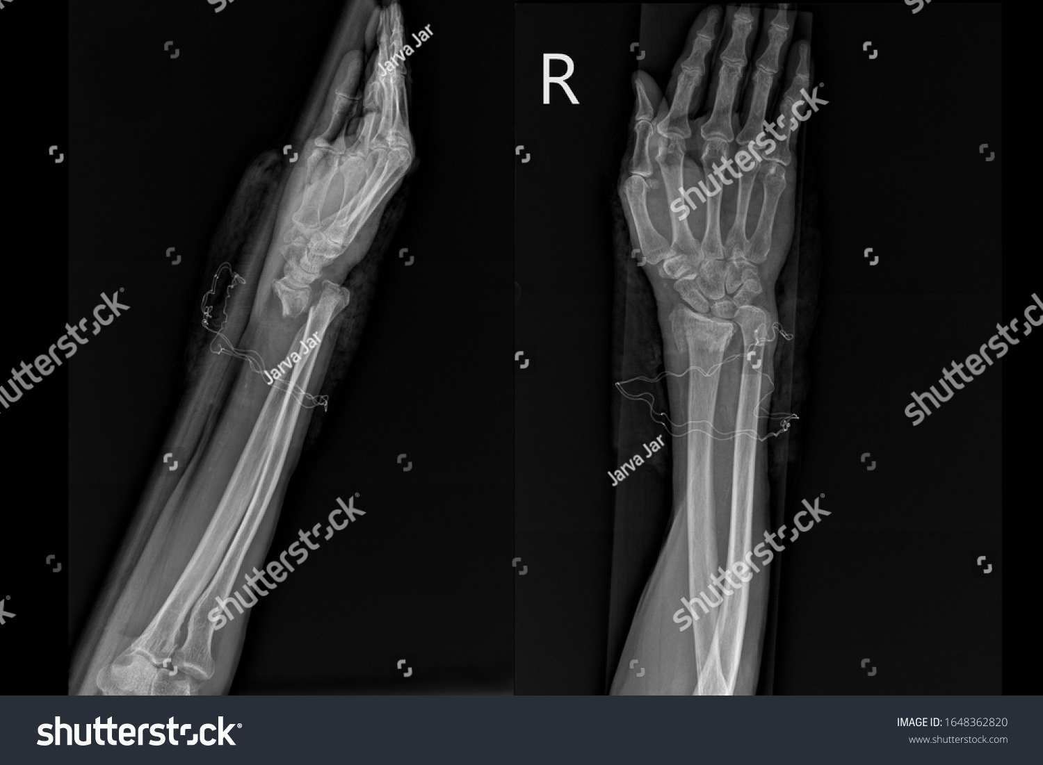 Xray Image Show Closed Fracture Radius Stock Photo 1648362820 ...