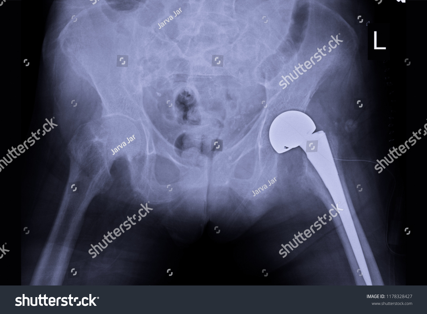 Xray Image Show Total Hip Replacement Stock Photo (Edit Now) 1178328427