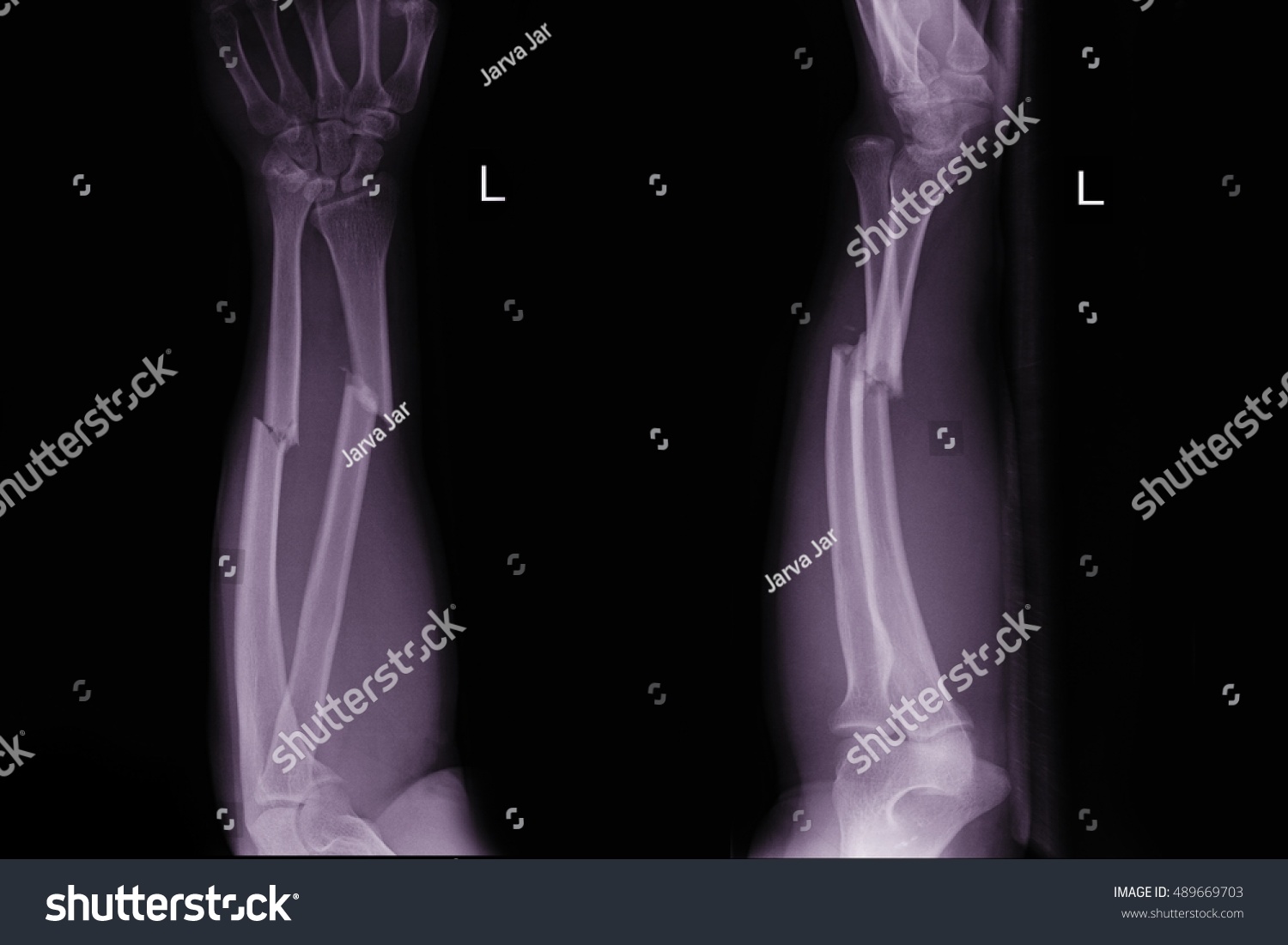 Xray Left Forearm Closed Fracture Stock Photo 489669703 | Shutterstock