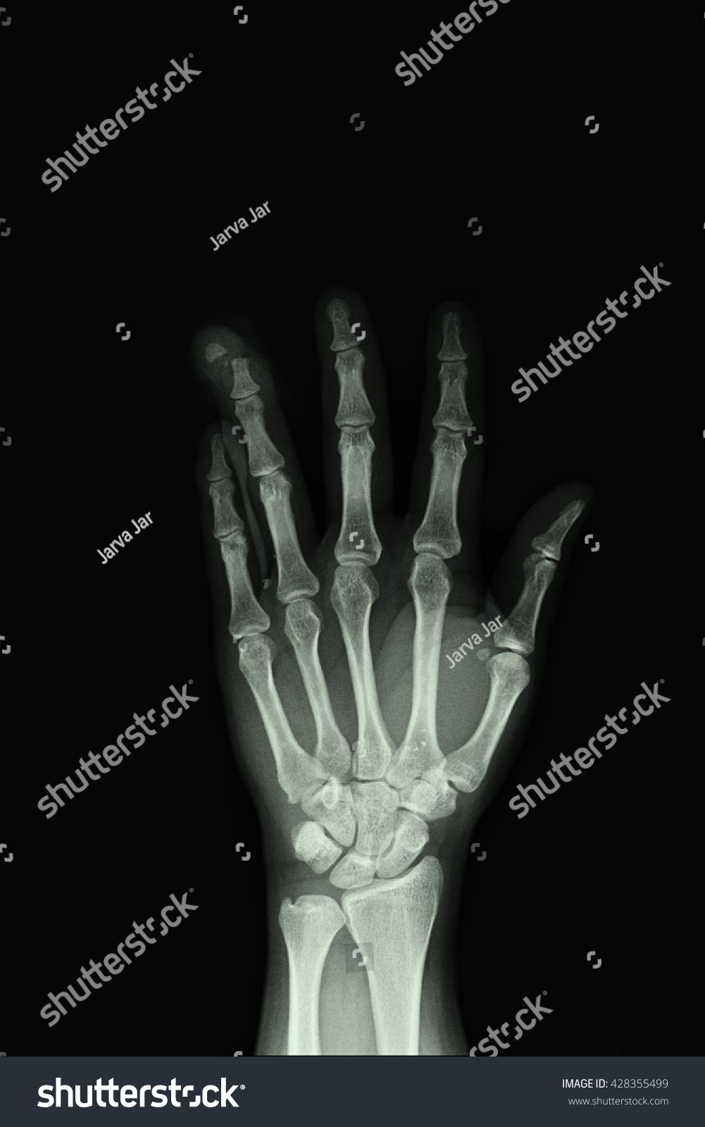 Xray Left Hand Show Fracture Ring Stock Photo 410271379 | Shutterstock