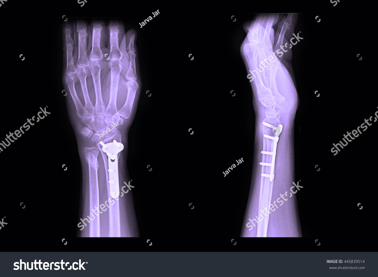 Xray Left Wrist Fracture Raduis Stock Photo 445839514 | Shutterstock