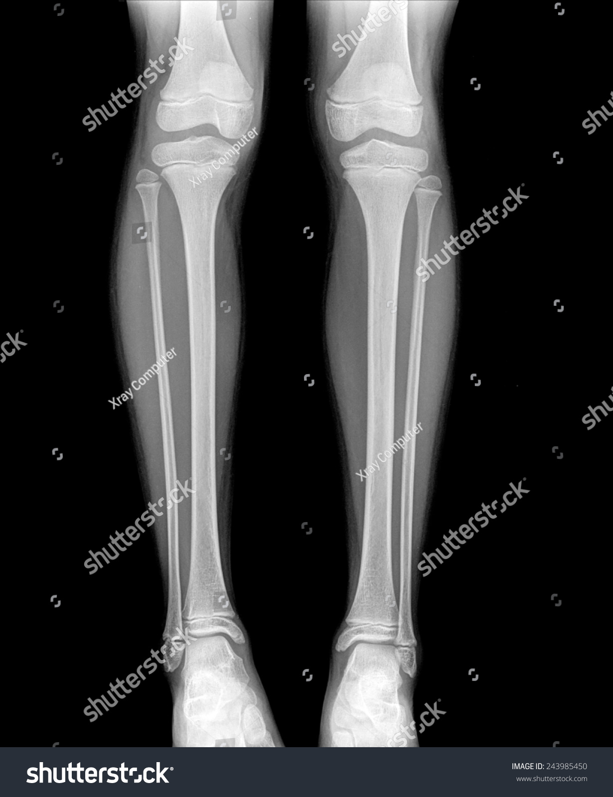 Xray Normal Leg Childe Image Stock Photo 243985450 - Shutterstock