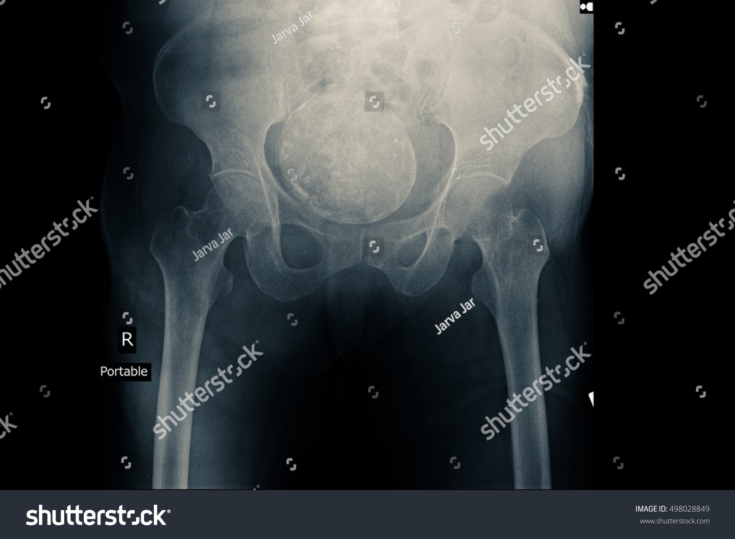ovarian cancer on x ray)