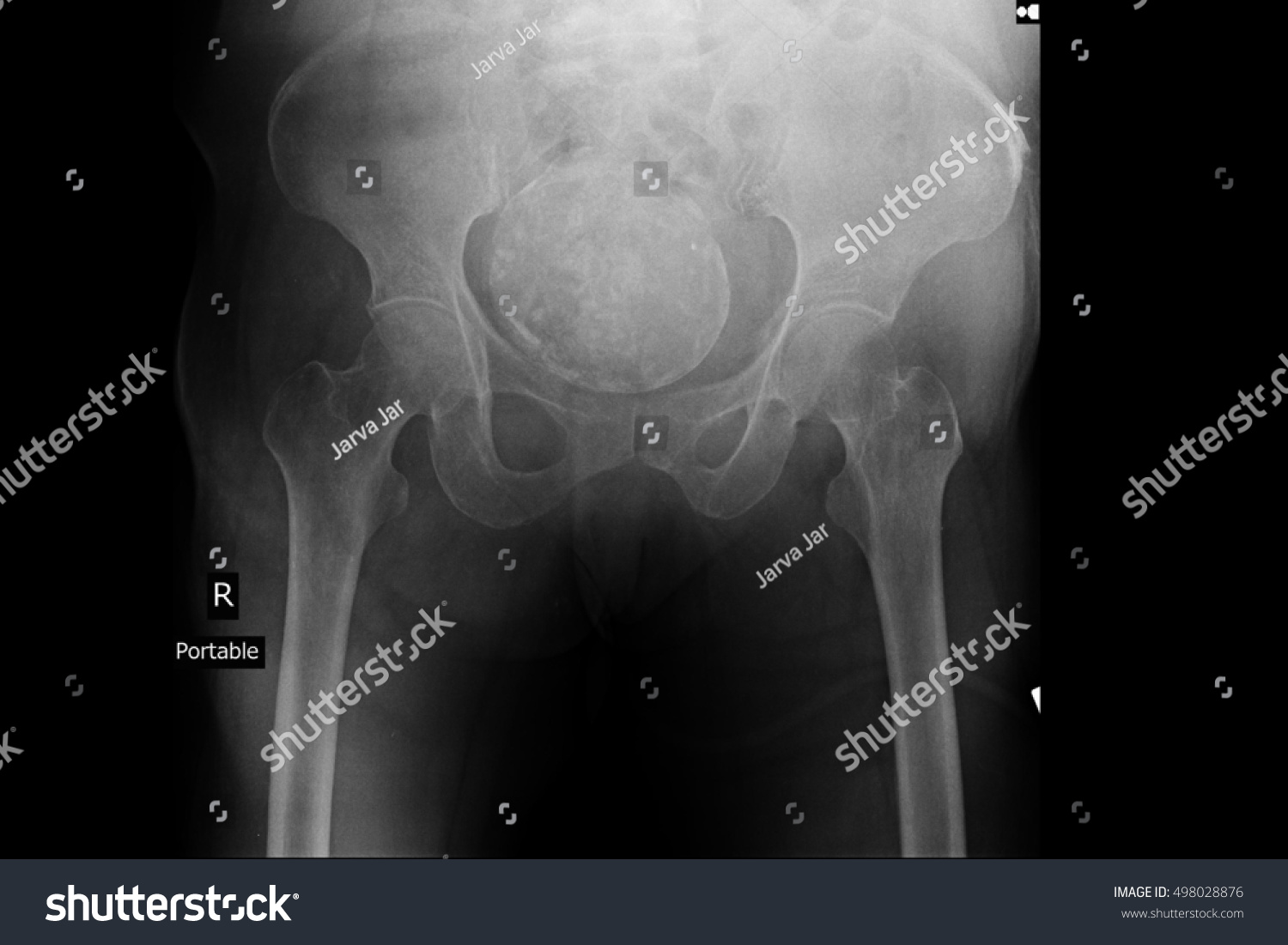 Xray Pelvis Show Ovarian Cancer Stock Photo 498028876 Shutterstock