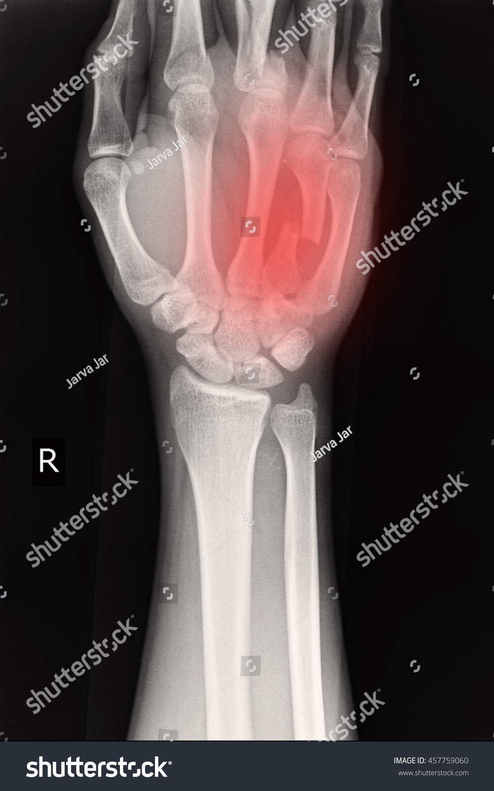 Xray Right Wrist Show Fracture Ring Stock Photo (Edit Now) 457759060