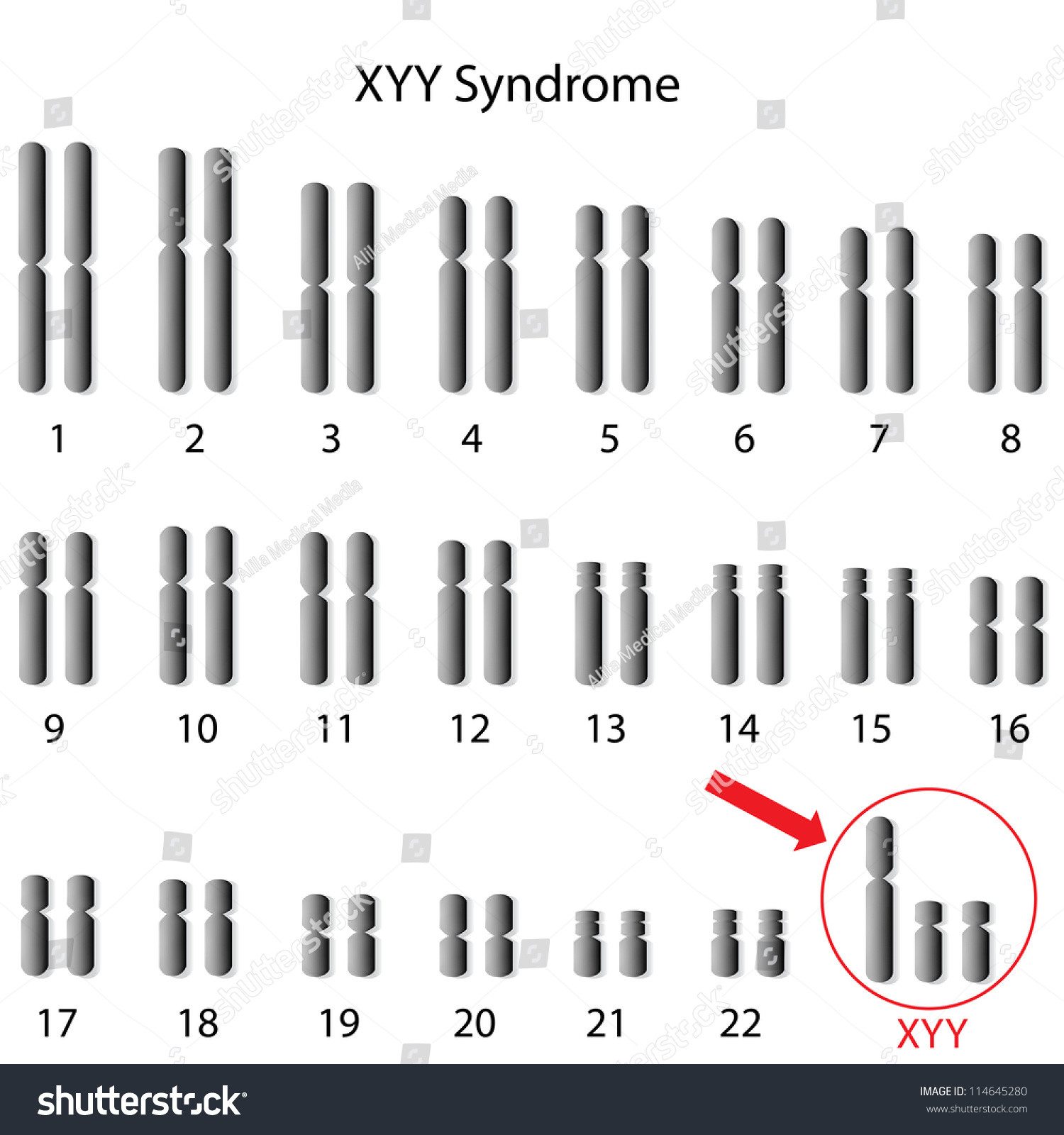 Xyy Super Male Syndrome Genome Stock Illustration 114645280 Shutterstock