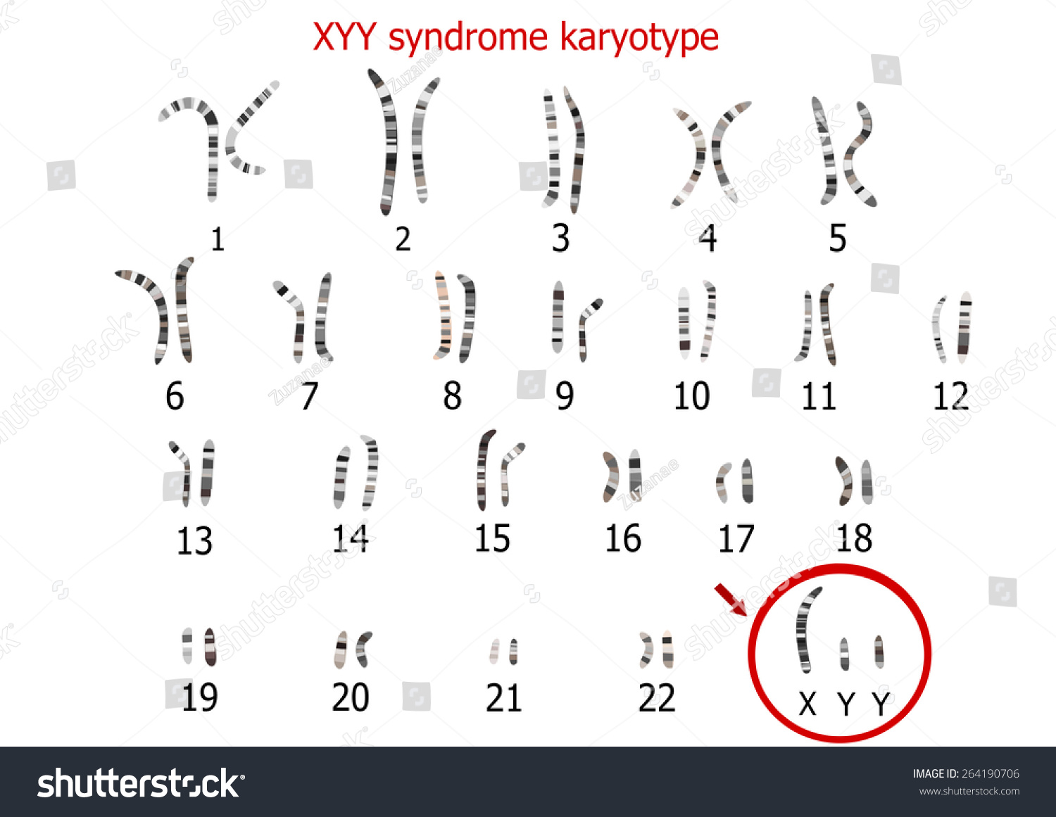 Xyy Syndrome Karyotype Stock Illustration 264190706 - Shutterstock