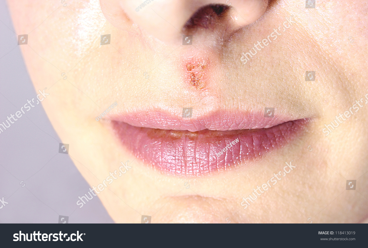 Young Woman Who Appeared Herpes On The Face,Herpes,Photography ...